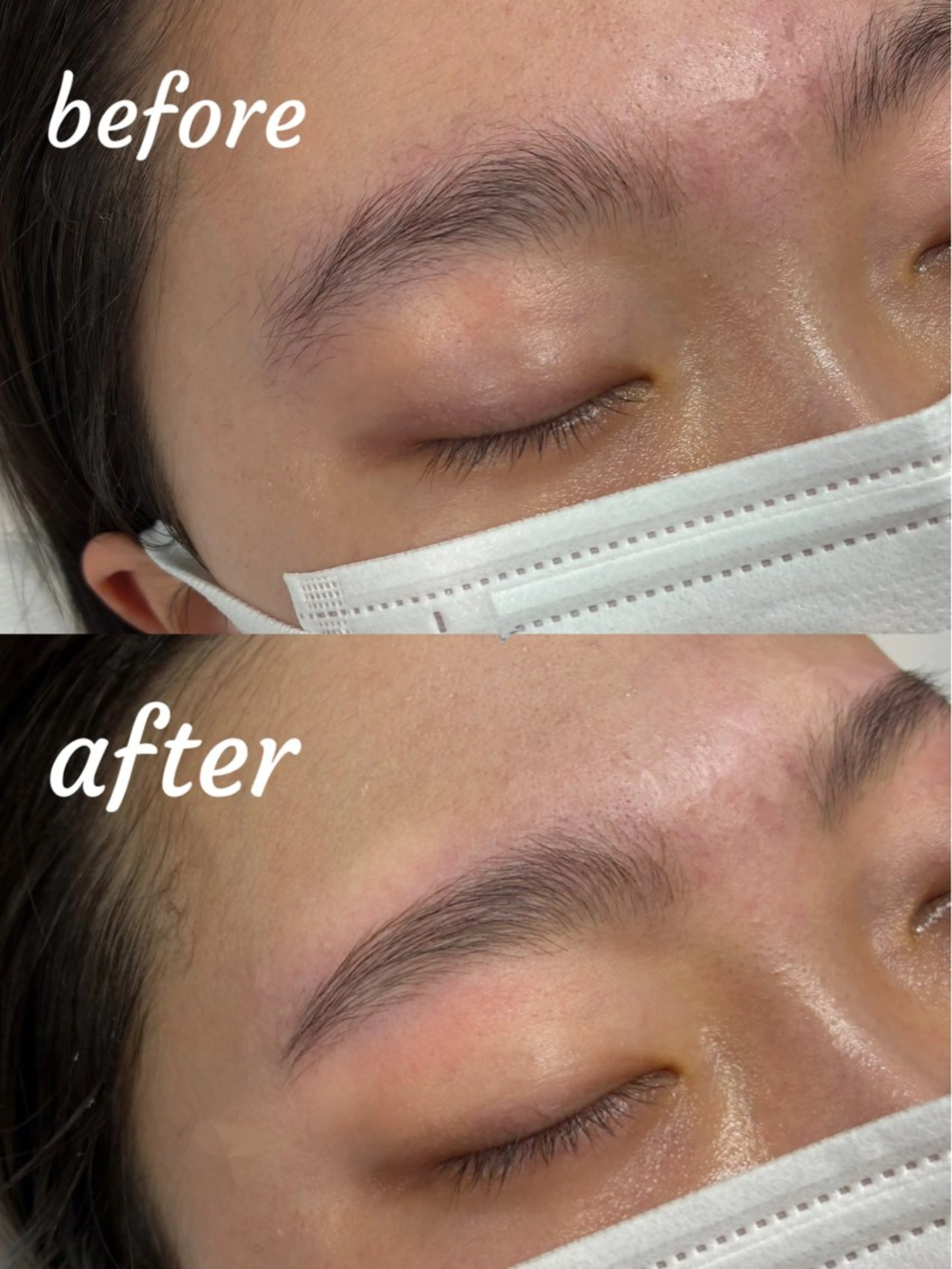 ブロウリフトの写真