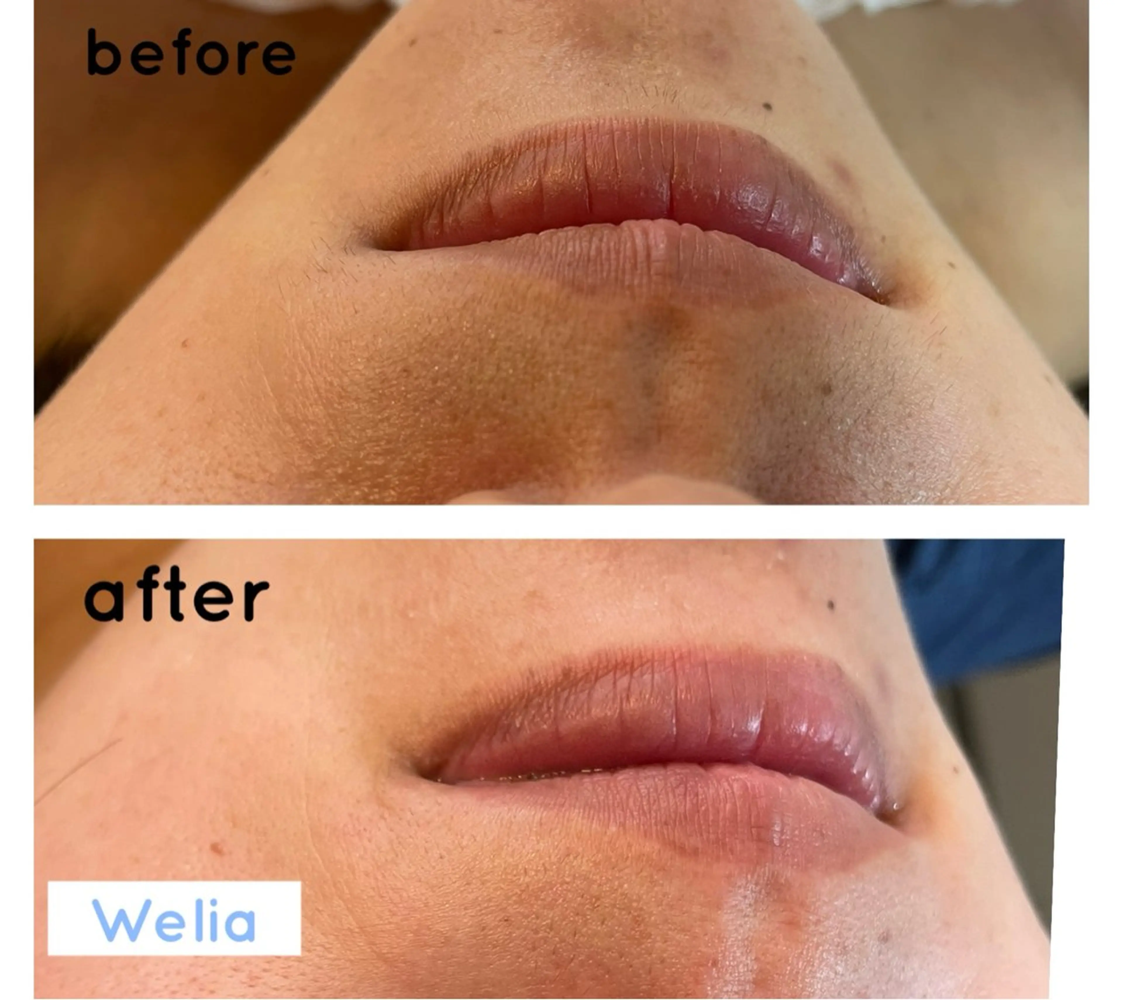 【ご新規様限定】お顔の産毛！一部位お試し！糸脱毛¥1500の写真