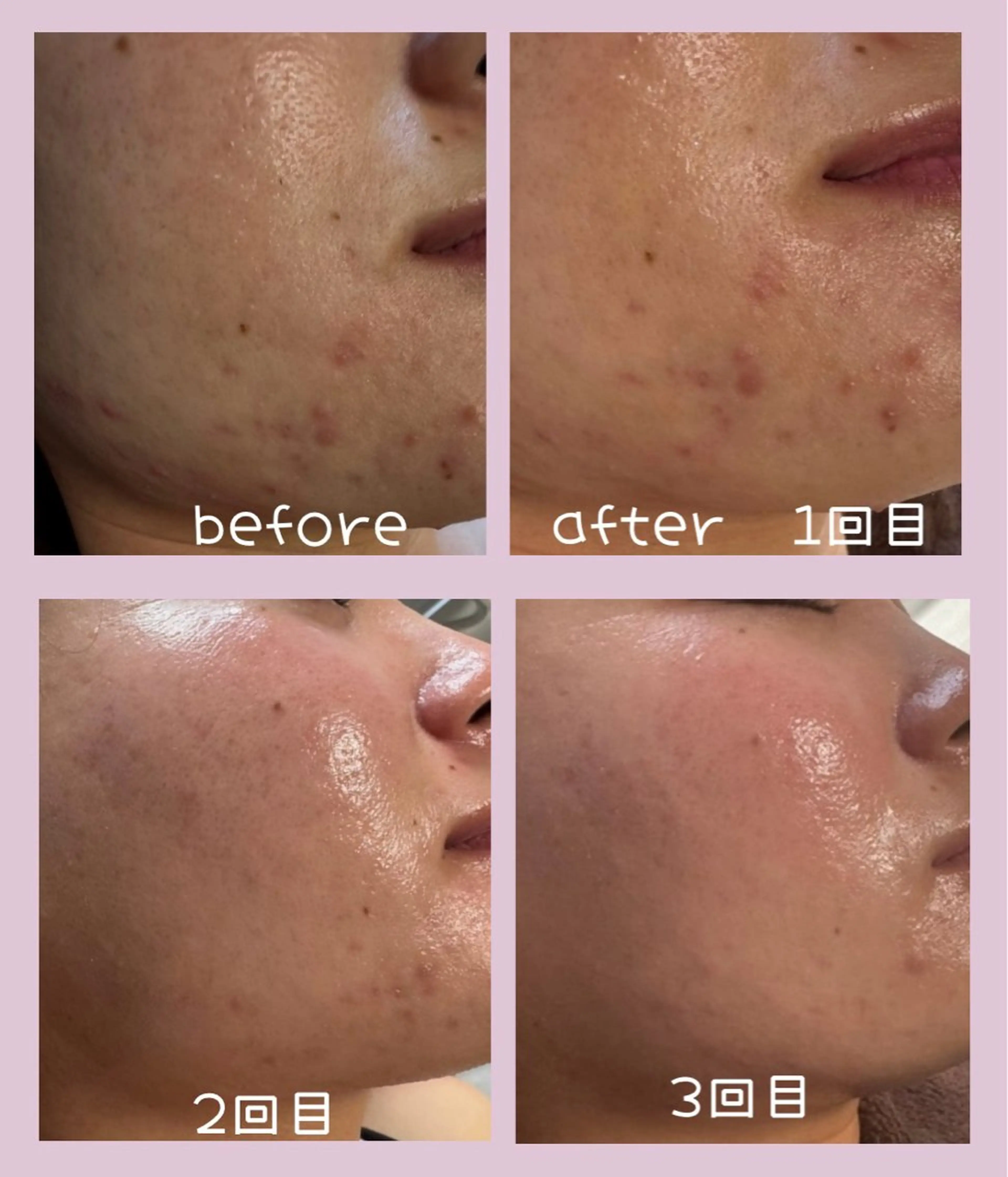 肌管理フェイシャル｜Utouto所属・肌管理フェイシャル Utoutoのエステ・リラクイメージ