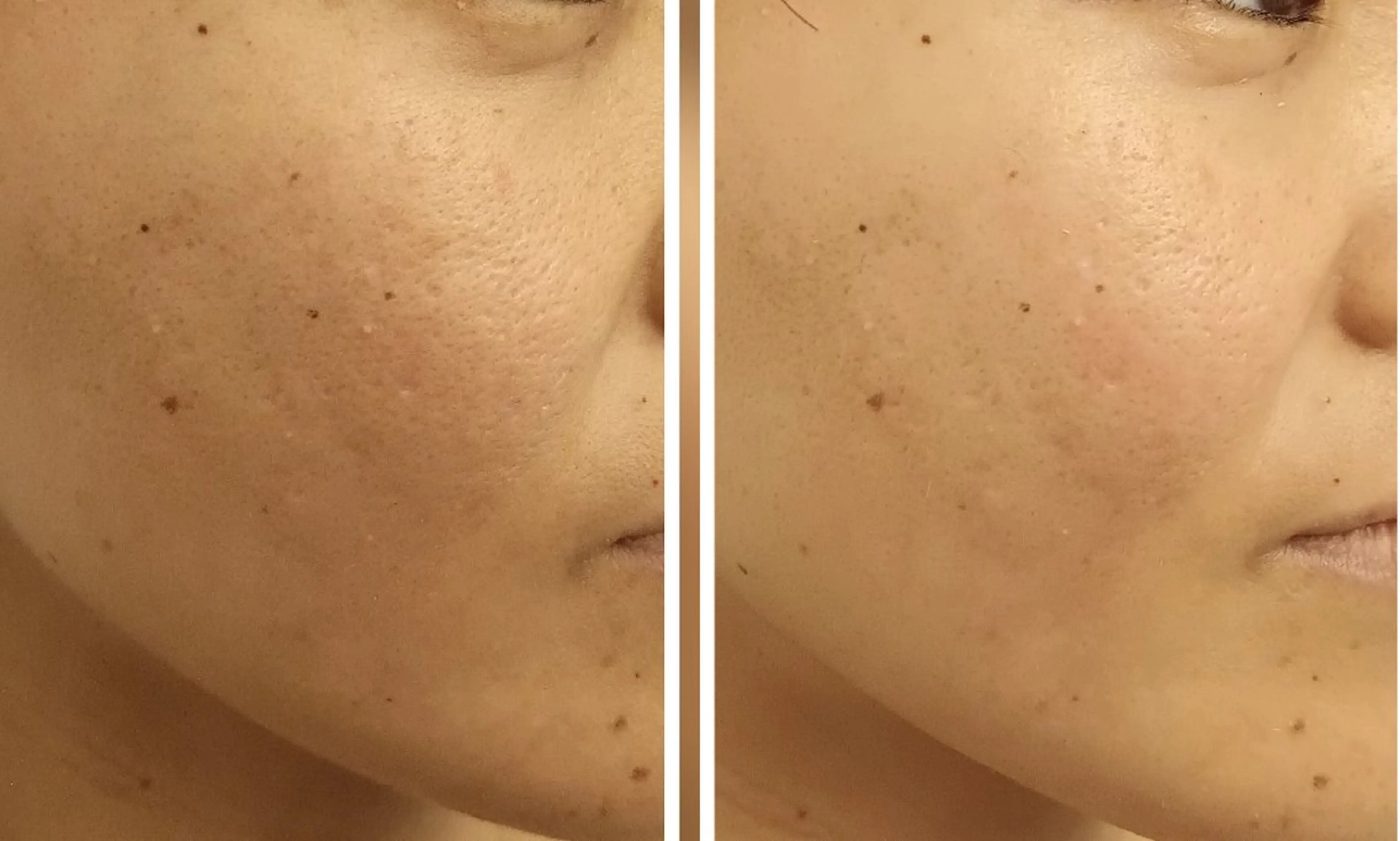 水光肌ピーリング ハーブピーリングのエステ・リラクイメージ