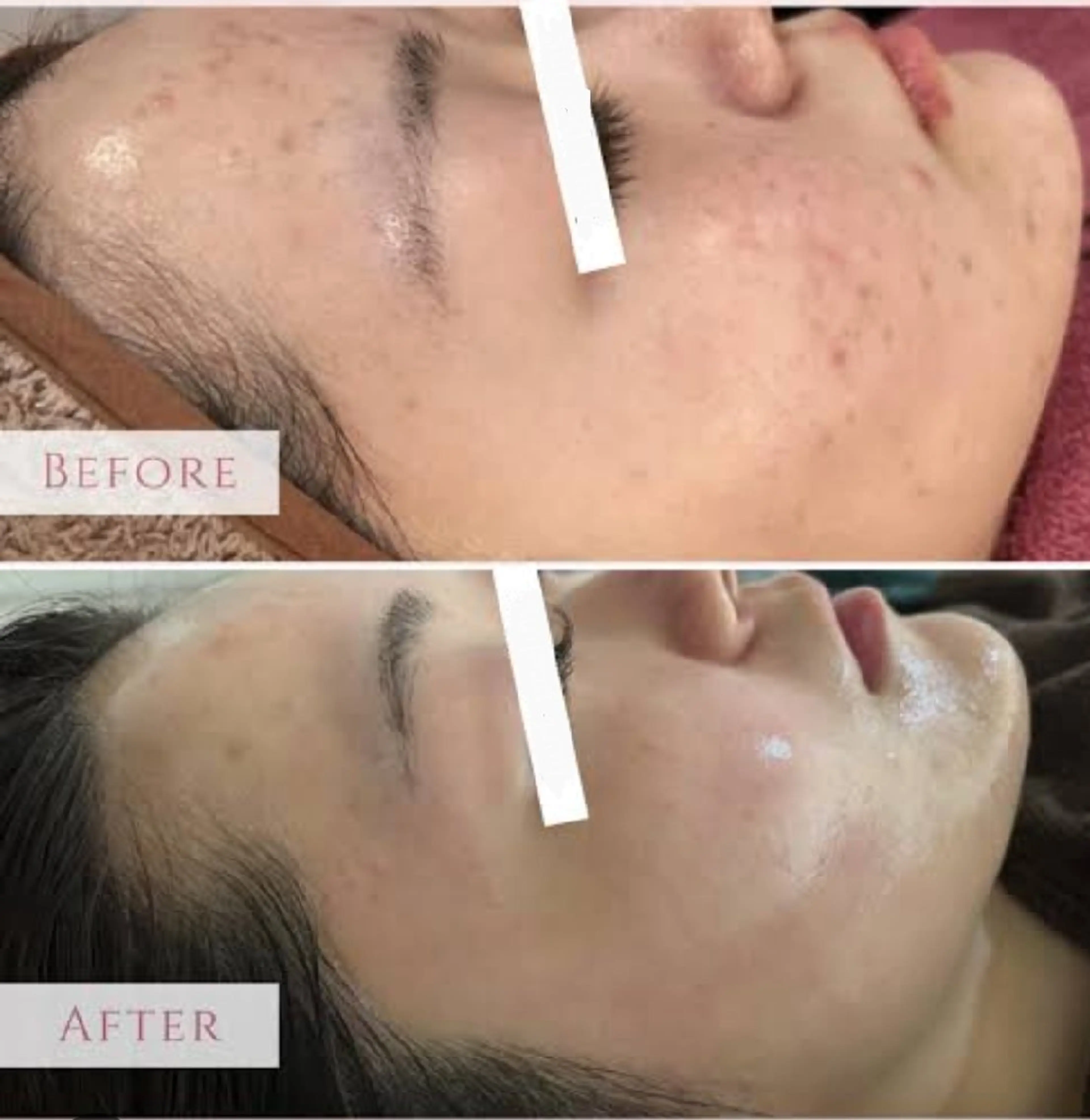 エステ エイジングケアサロンBIOEL所属・肌質改善BIOELプ ラズマ/ラミピールのエステ・リラクイメージ