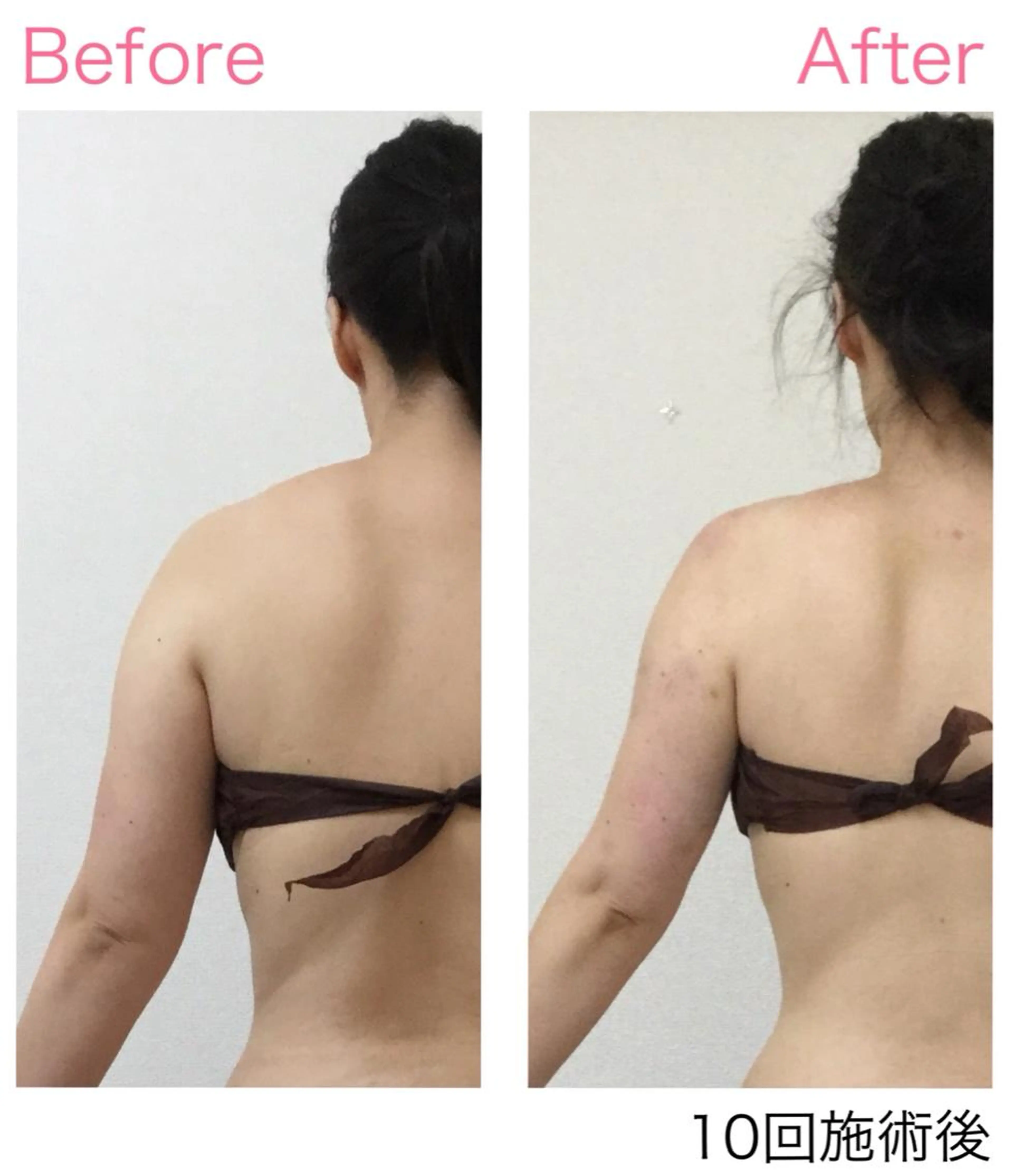 ★モニター募集  上半身痩せ   60分  10回【二の腕・背中・腰】の写真