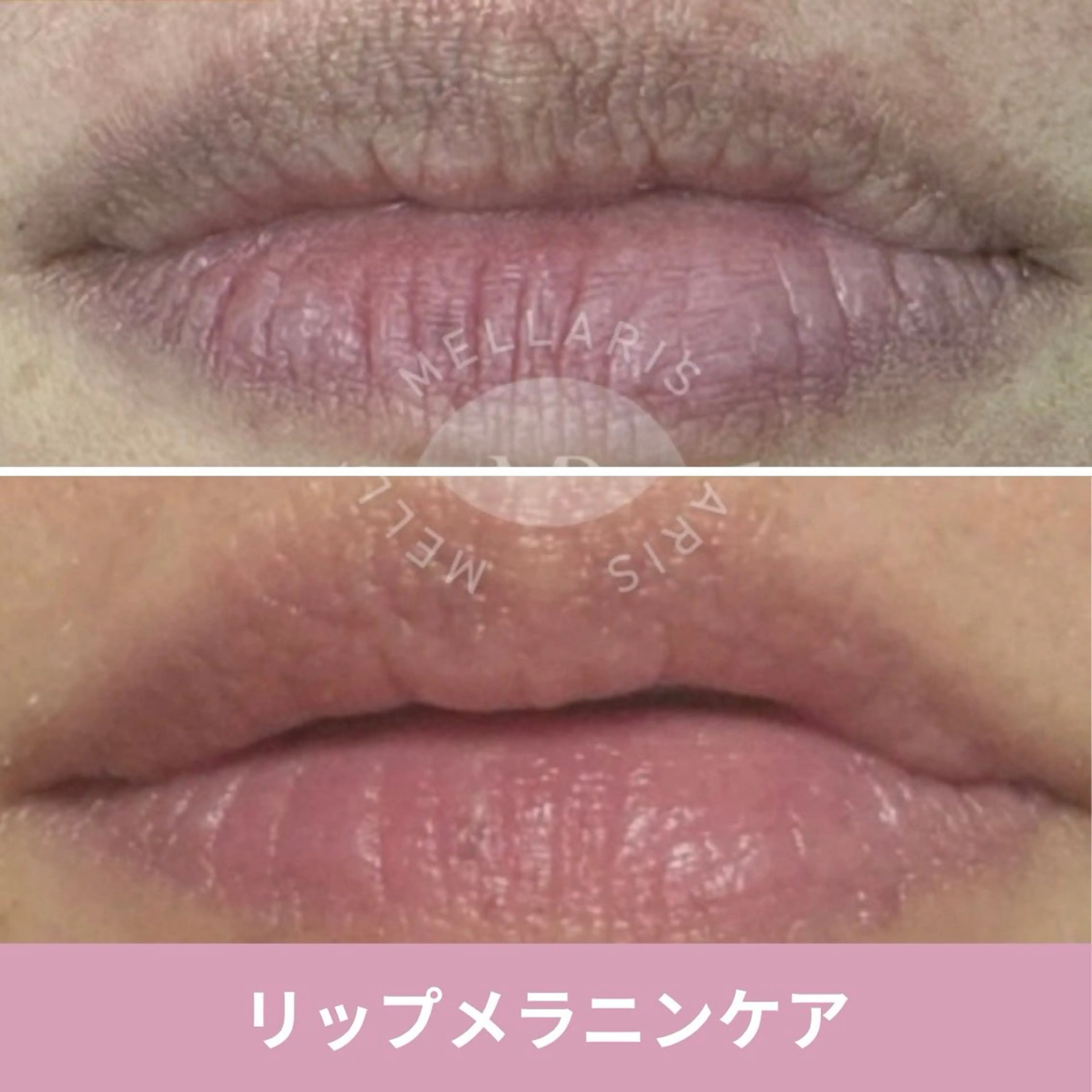 【1/17​〜​】リップ黒ずみ除去💋アフターケアクリーム付！国産メラニンケア✨唇をピンクに！ルメラ・ローマピンクの次世代版の写真