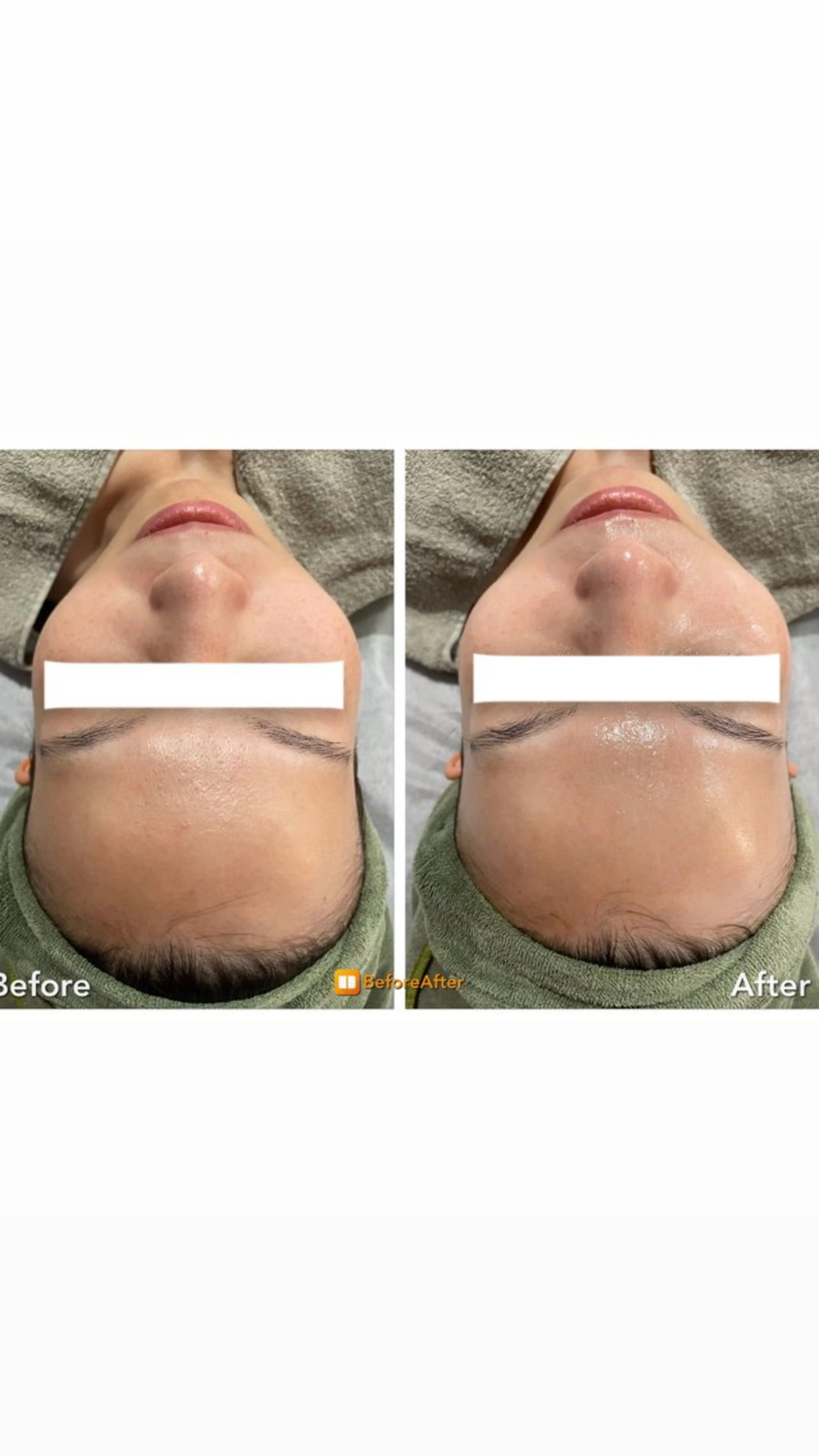 エステ Meupニキビ専門店 背中/ハーブ/肌管理のその他イメージ