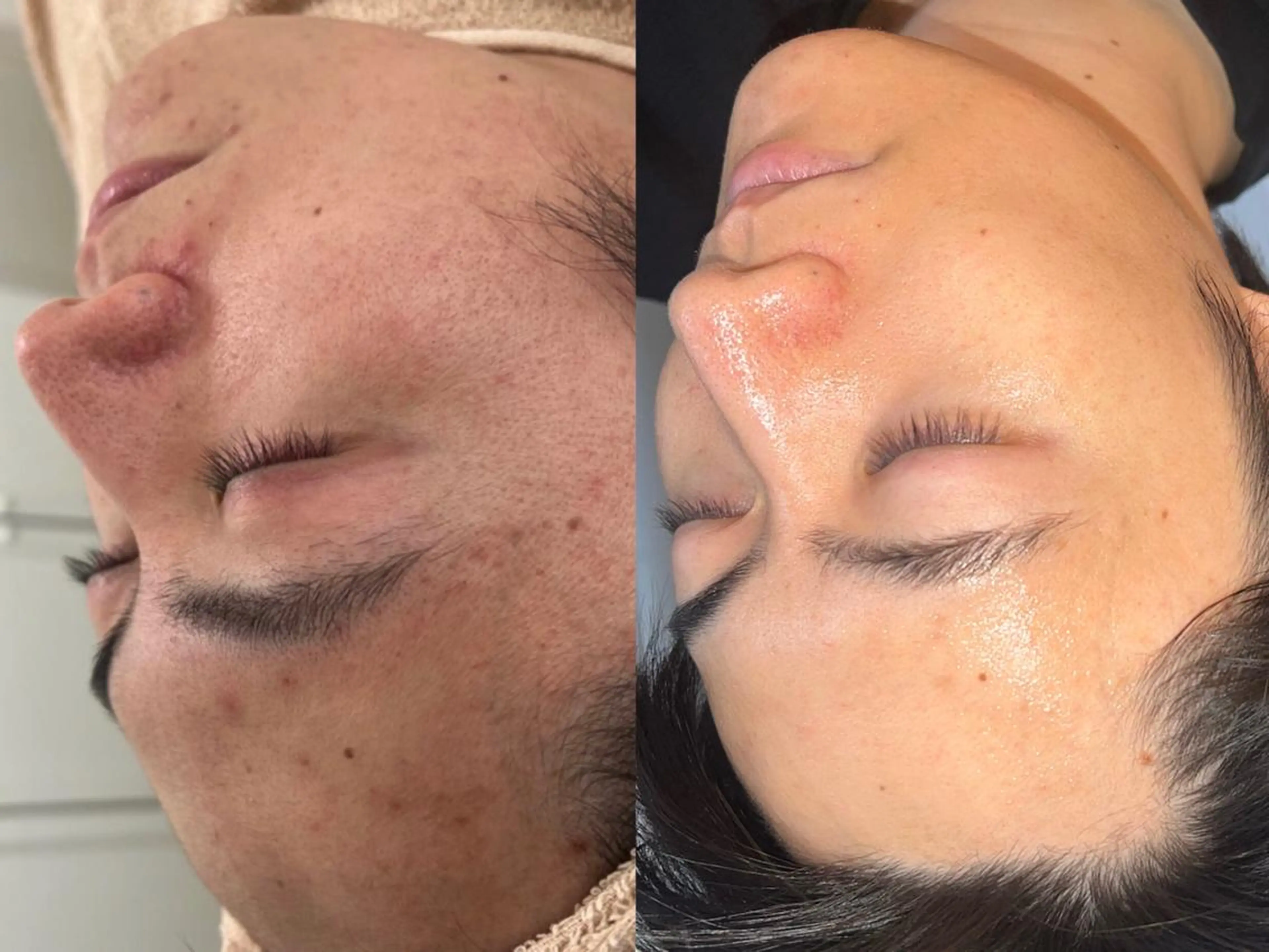 ハーブピーリング /毛穴ケア/脱毛/韓国ツヤ肌専門店【HARU.】所属・韓国ツヤ肌ピーリング ハーブ脱毛HARU.のエステ・リラクイメージ