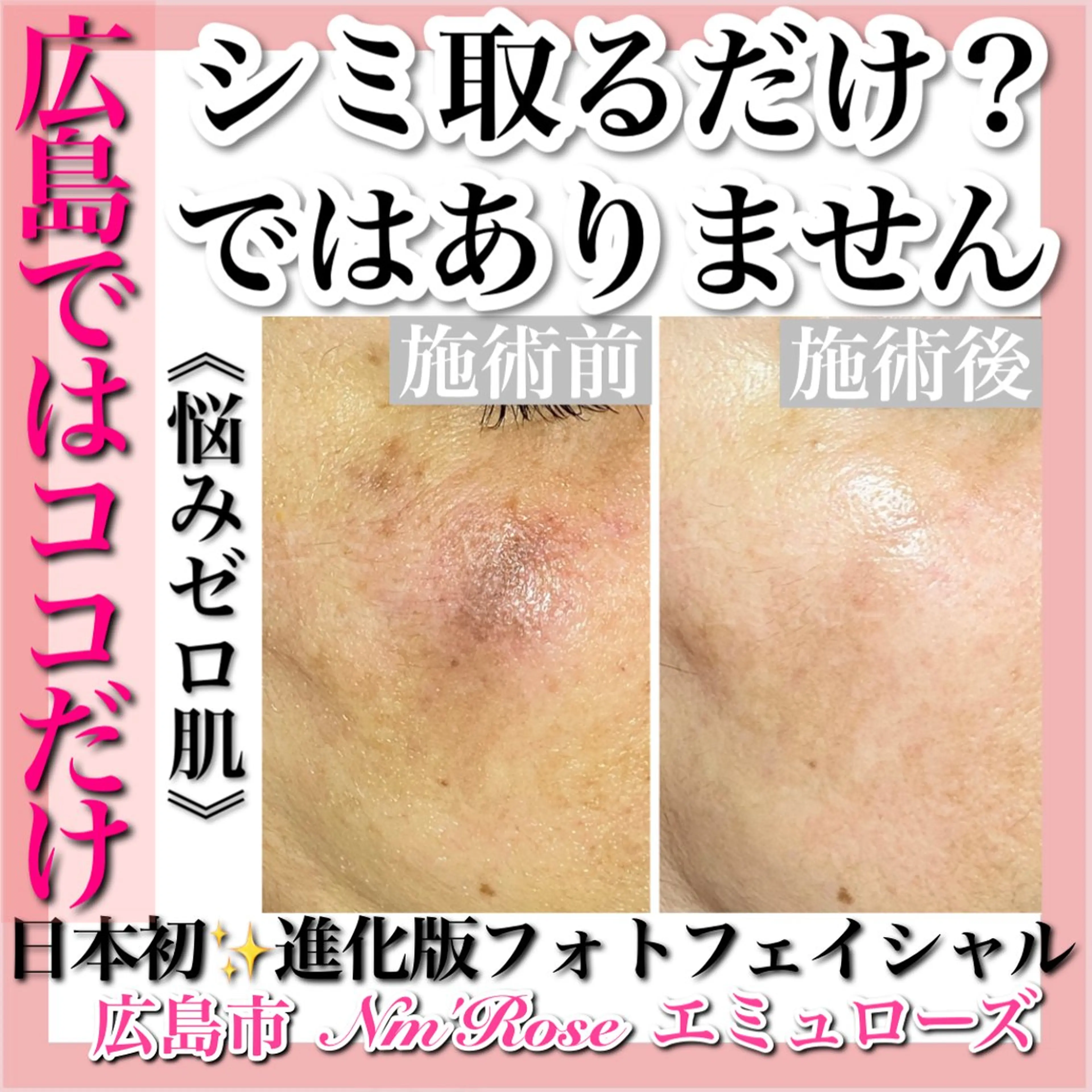 毛穴と光打ち放題の最強メニューの写真