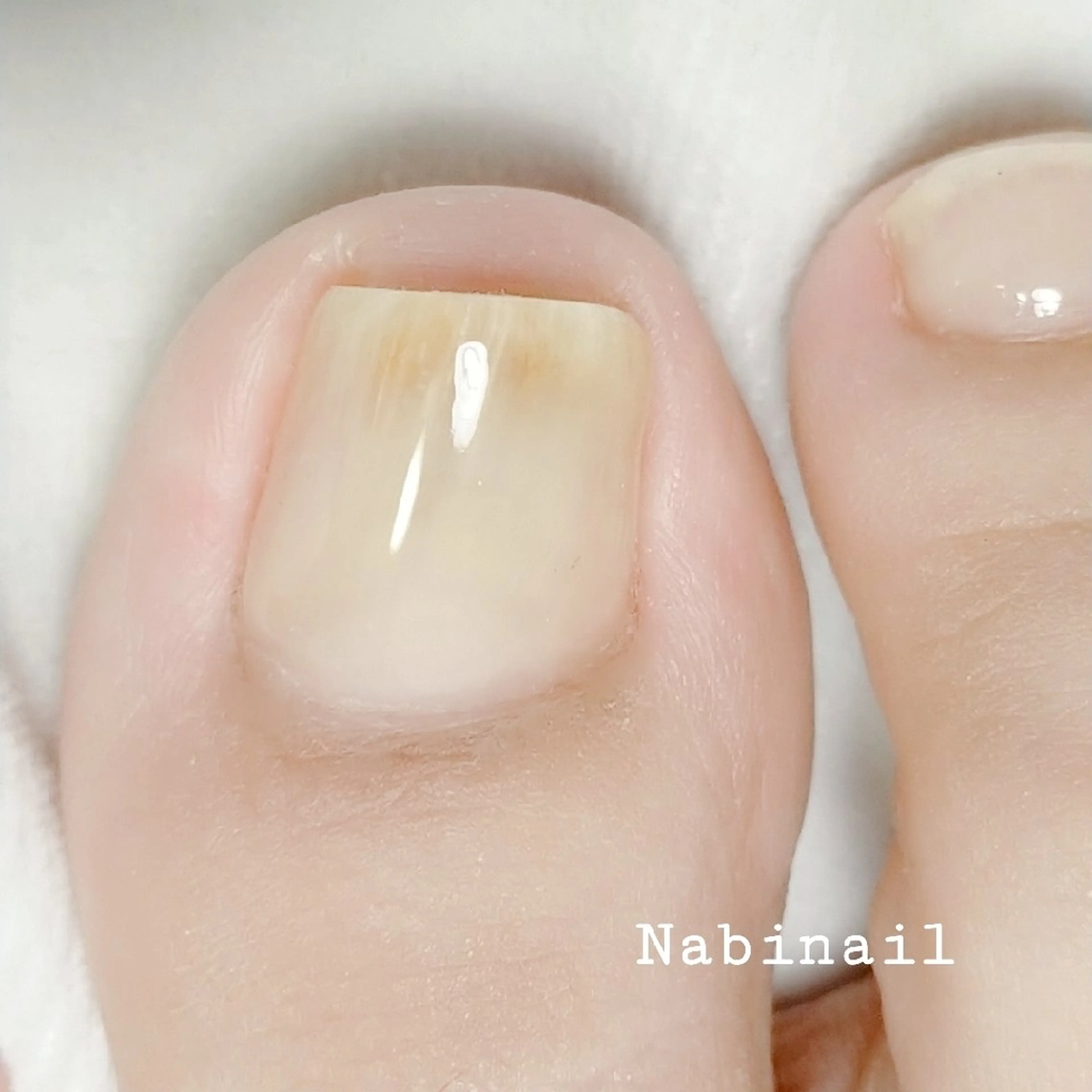 巻き爪対応ジェル(フットケア付き)2本の写真