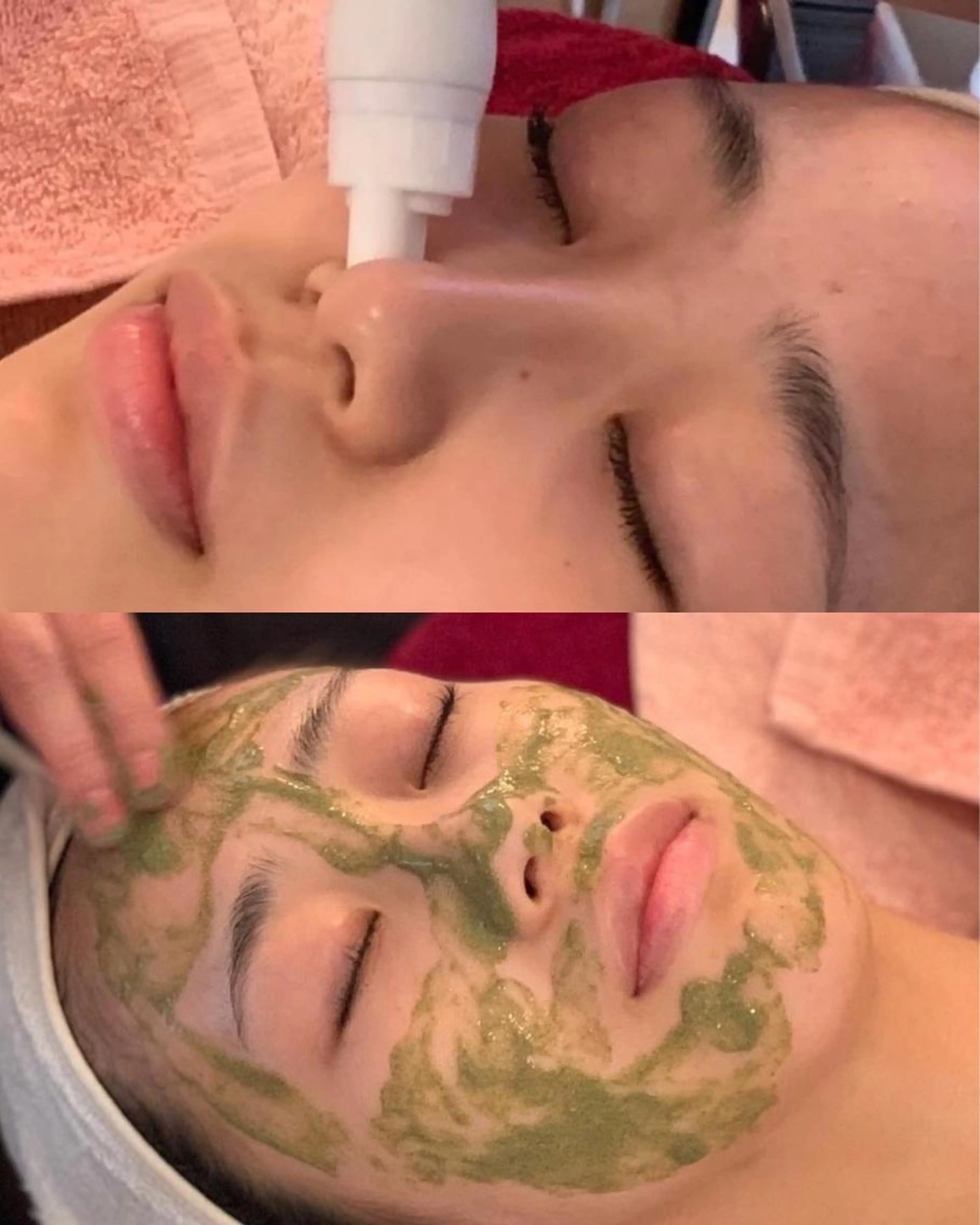 ハーブピーリング★ハイドラ毛穴洗浄のセット🈹の写真