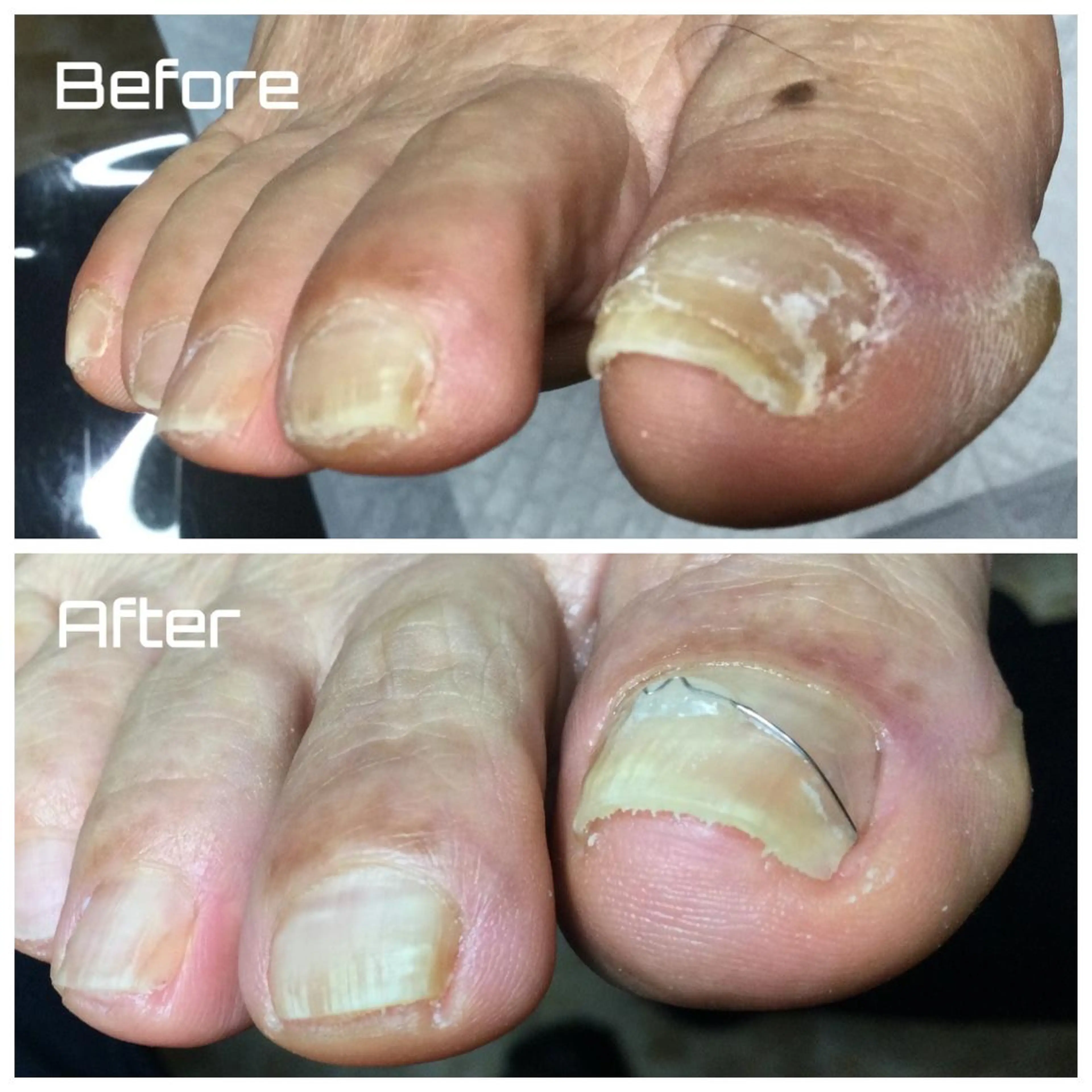 【足の専門家】巻き爪矯正1ヶ所+お爪切り【初診料別途550円】の写真