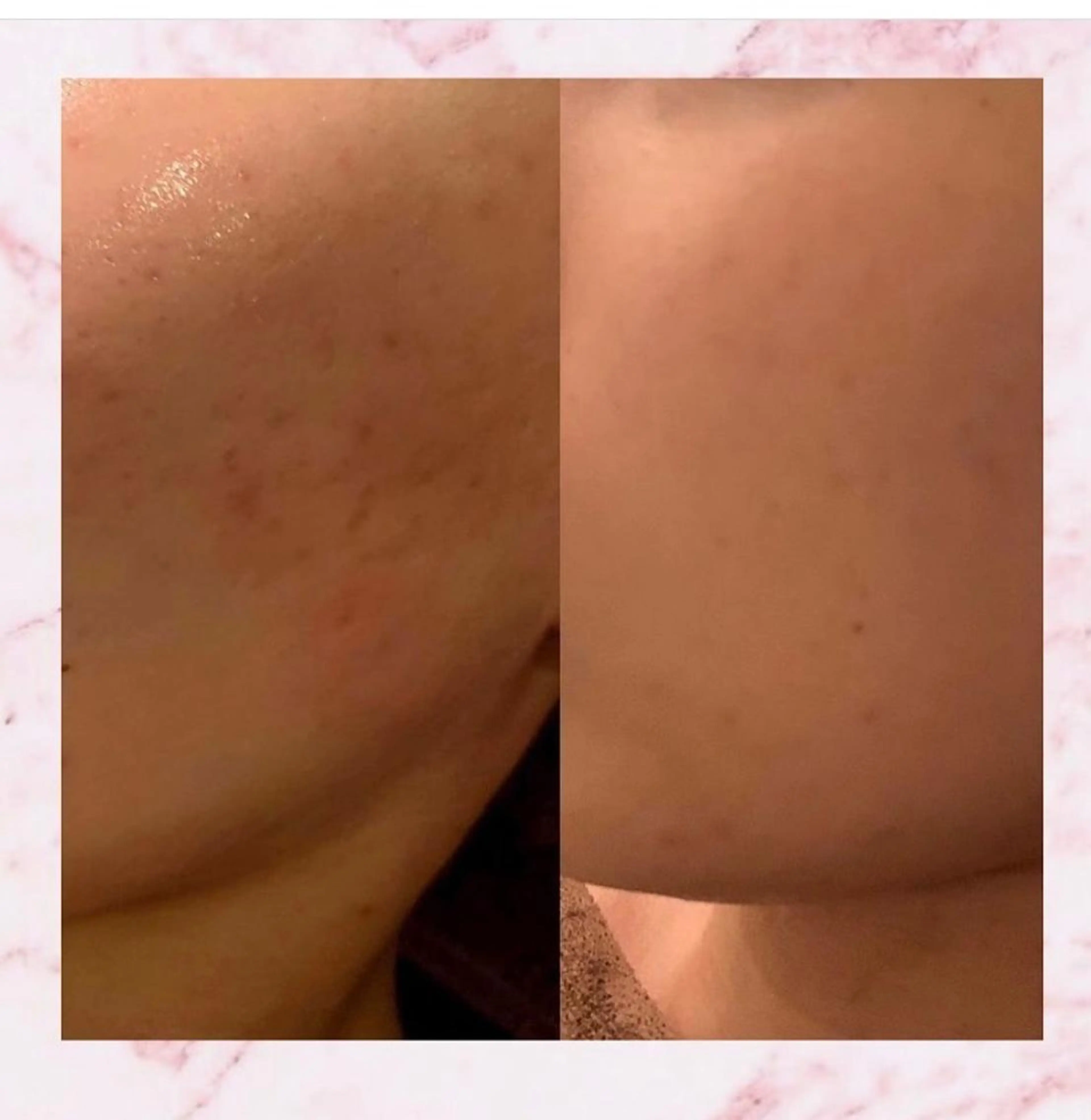 ハーブピーリング特選 認定rebirthのエステ・リラクイメージ