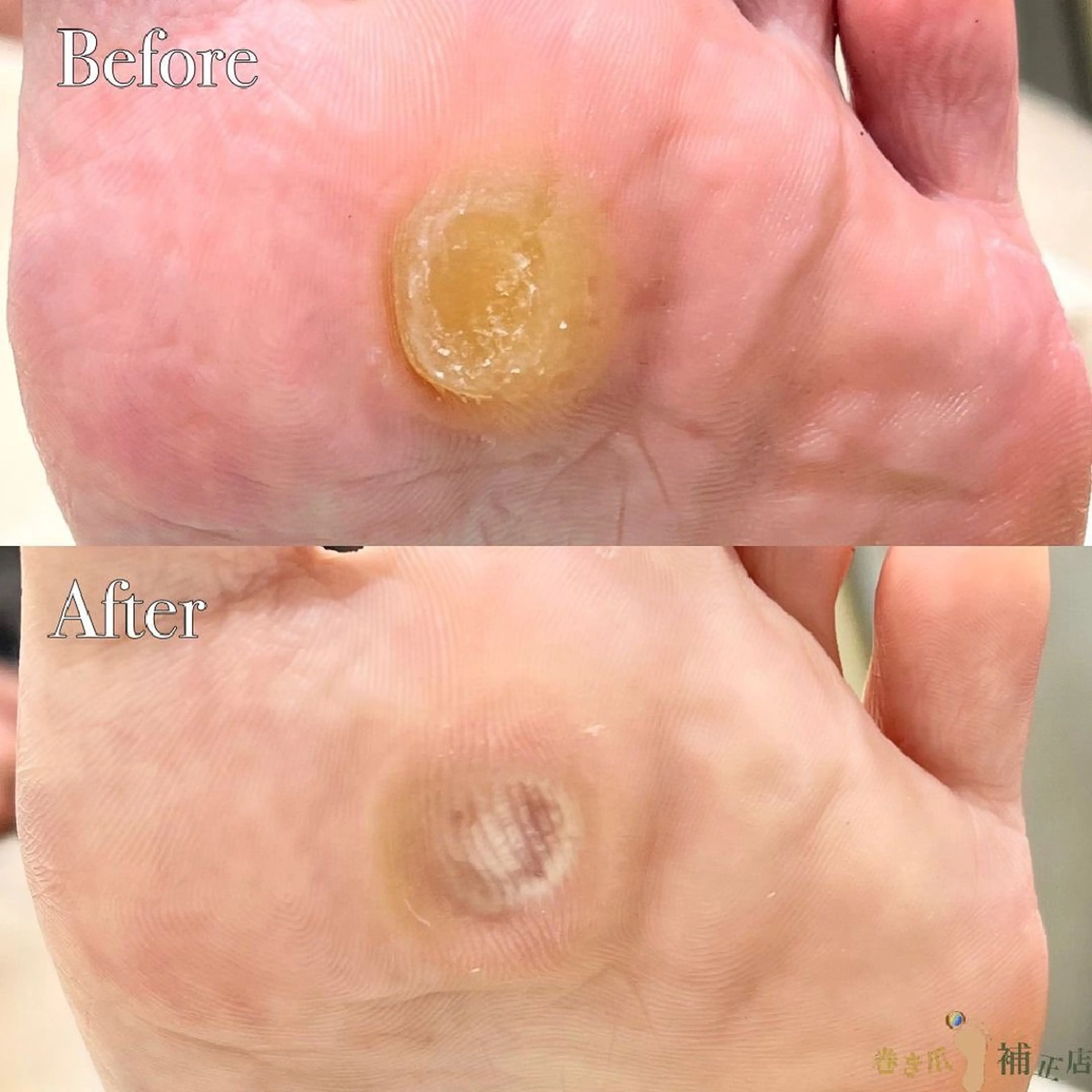 【足裏タコのケア】足裏ゴワゴワ角質・タコを綺麗に取り除きスベスベな足裏へ✨※かかとは含みません！の写真