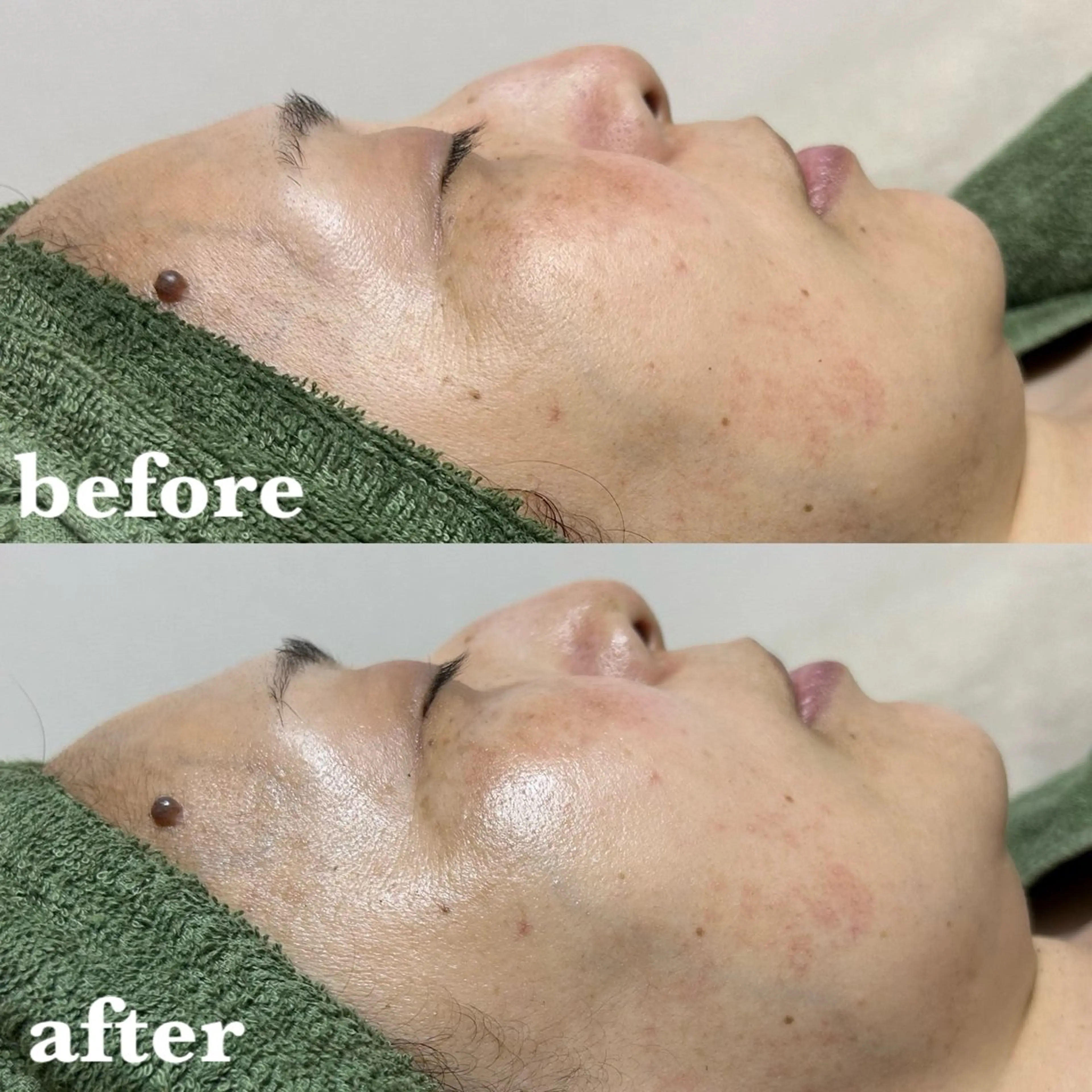 【エイジングケア･若化】陶肌トリートメント▶¥11,000(陶肌トリートメント1ｇプレゼント価格)の写真