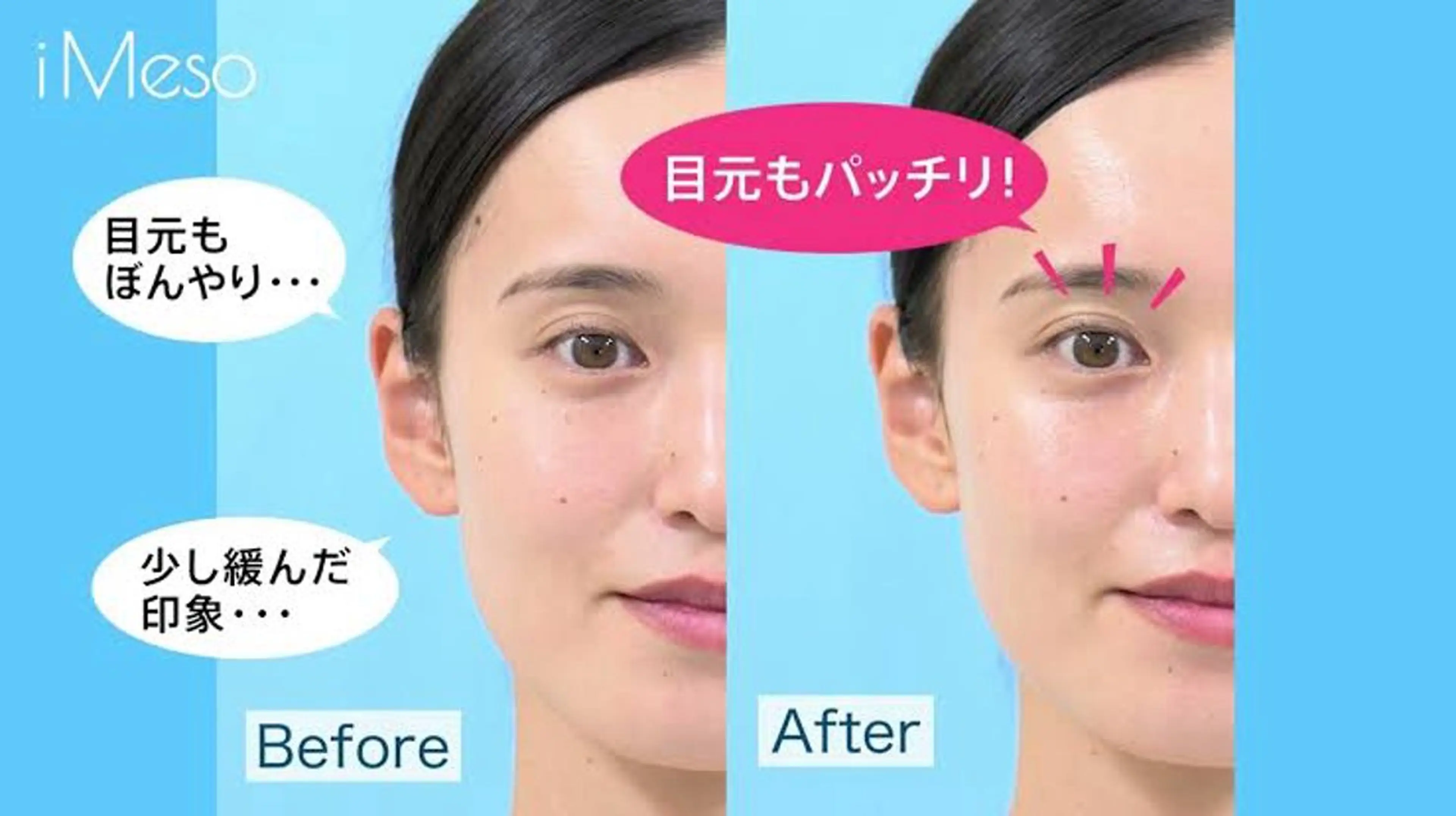 家庭用ダーマペン美顔器【iMeso(アイメソ)】体験コース☆ハリのある肌に♪ ・肌にハリを与えたい・目元や口元を集中ケアの写真