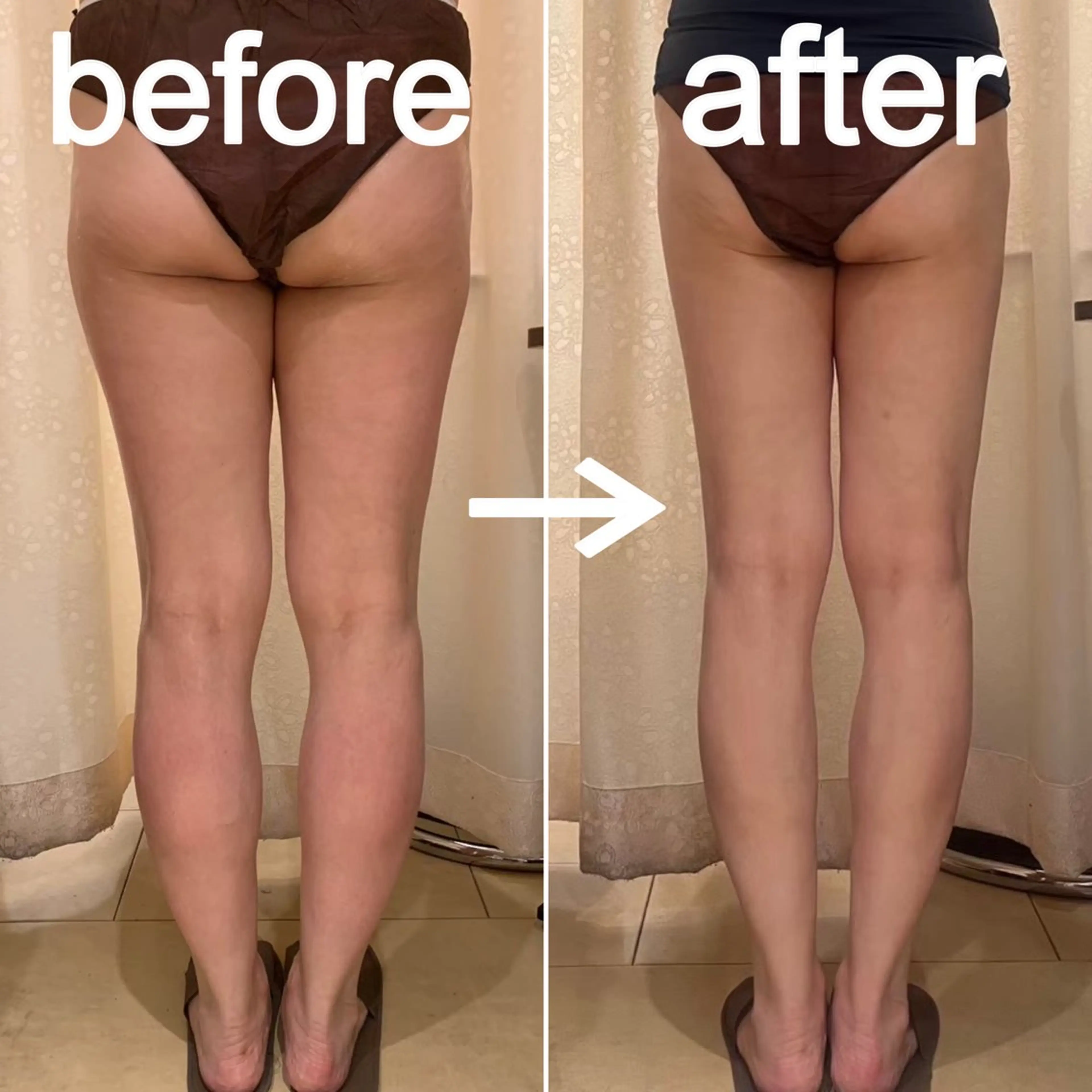 【1部位コース✨】リラクゼーション痩身/ハイパーナイフ15分の写真