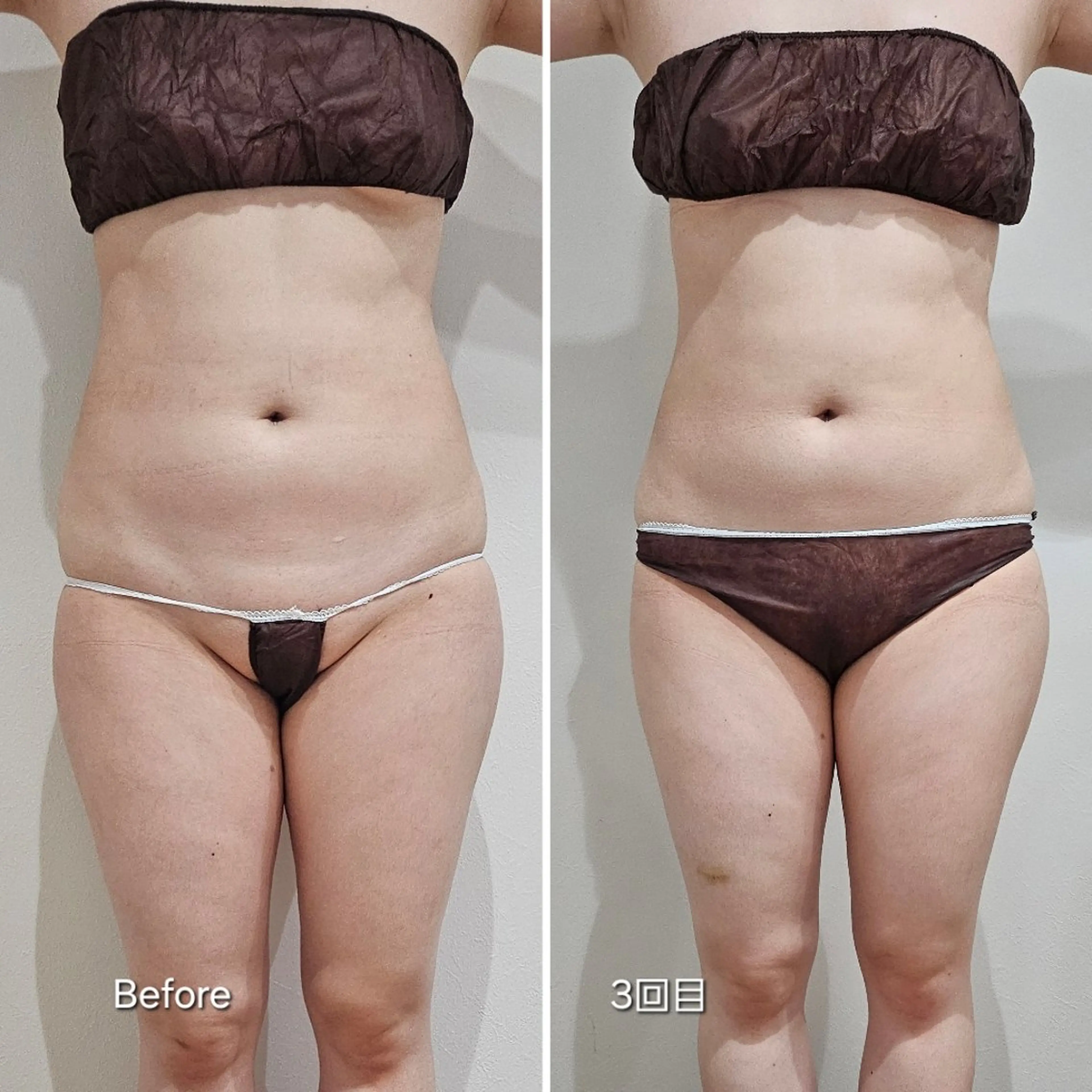 脂肪冷却 & 脱毛 AYUMIのその他イメージ