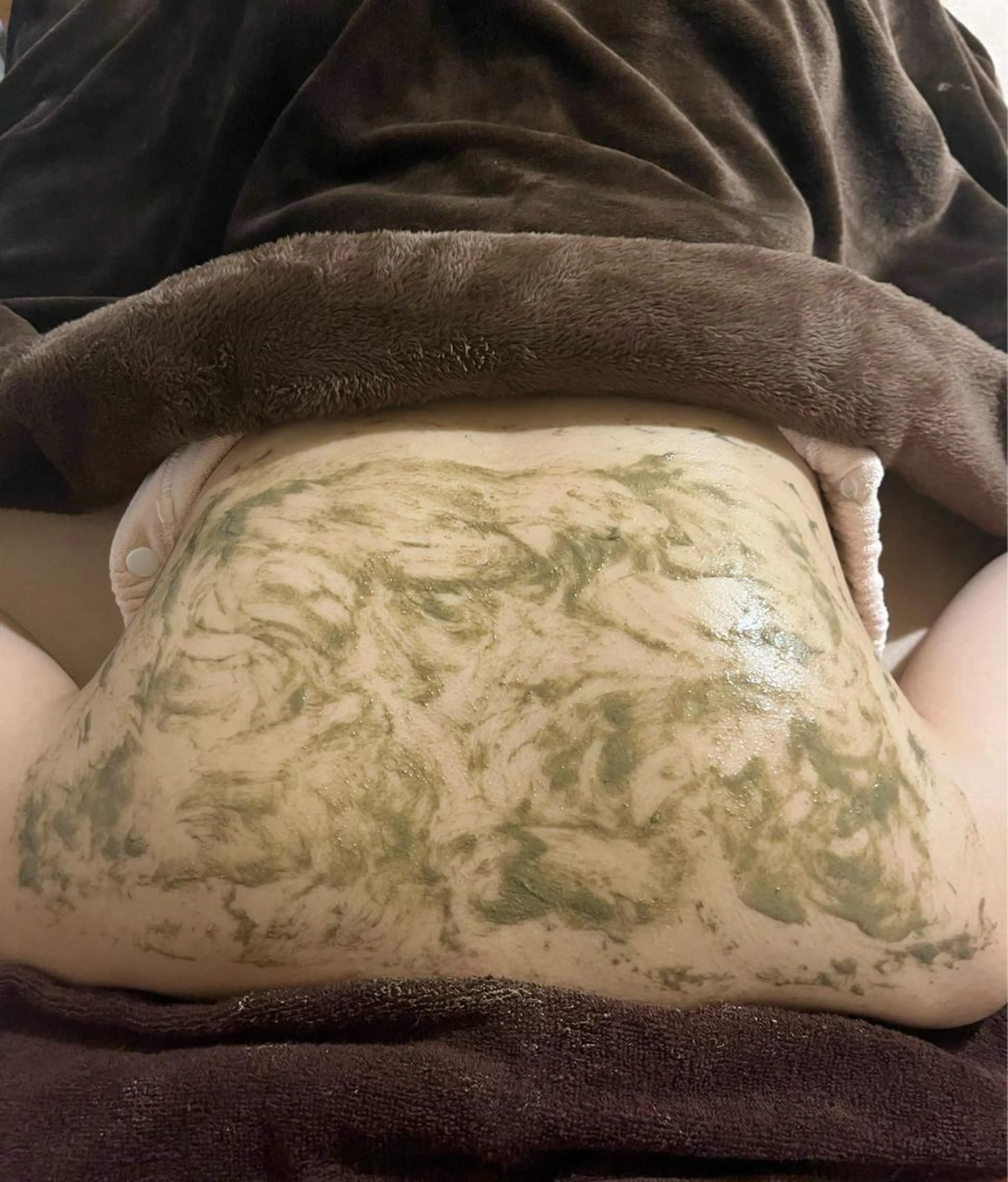 剥離なしソフト･ハーブピーリング背中🌿痛みなしダウンタイムなし✨即効ツヤ肌💎2週間に1回のケアで肌質改善◎の写真