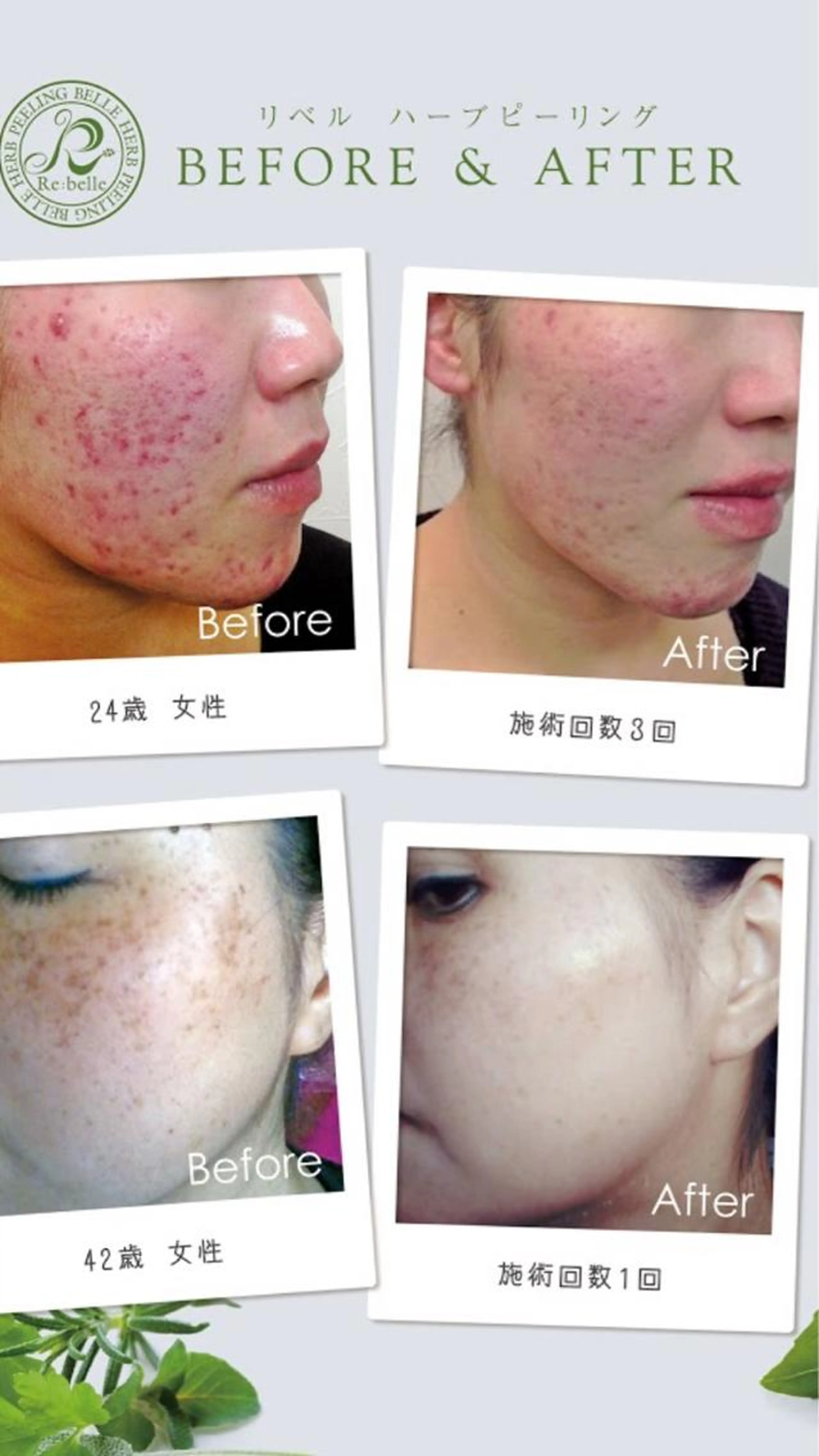 【ニキビ跡・ニキビに効果的】ハーブピーリングの写真