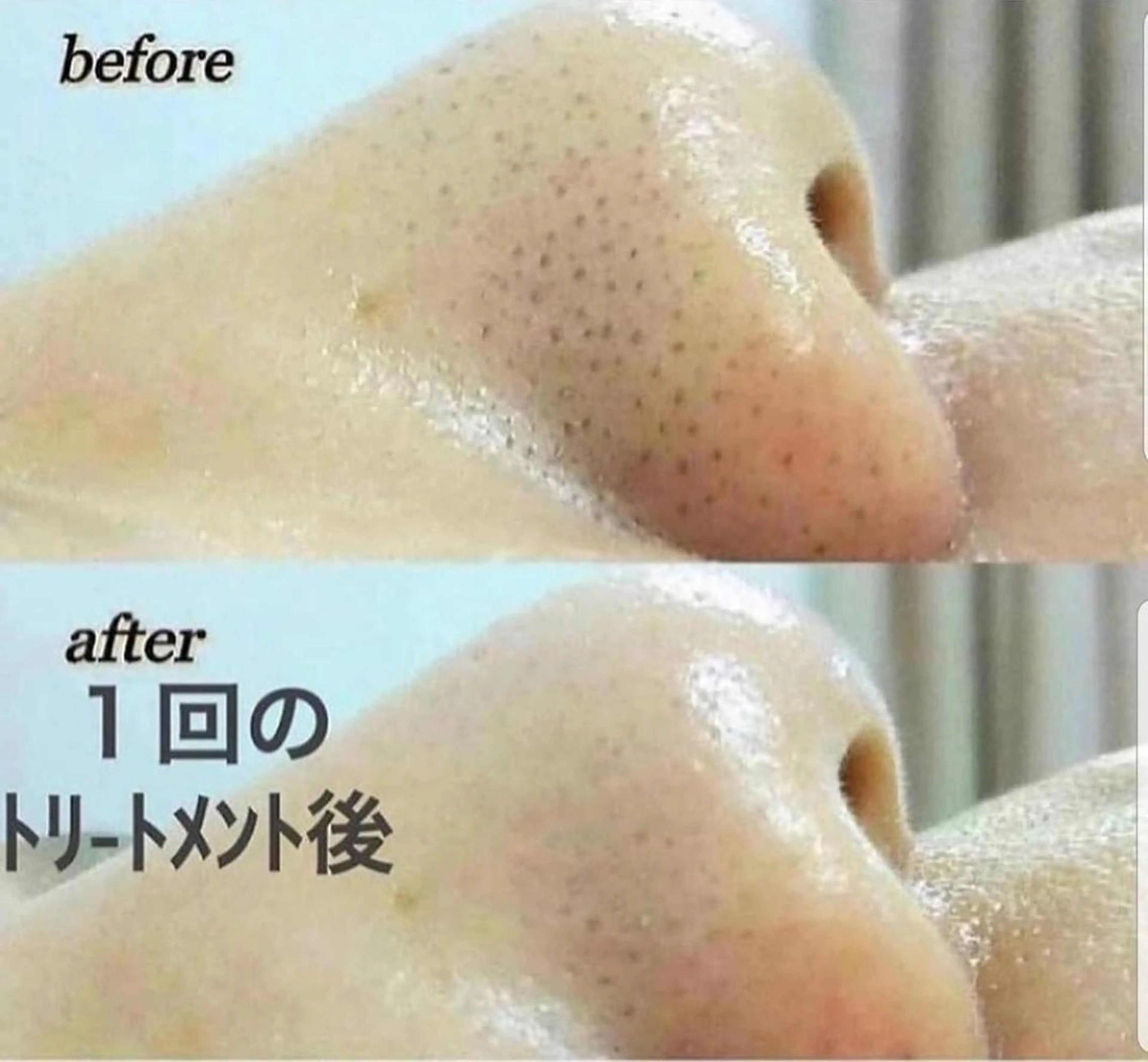 【小鼻ケア】《本気の毛穴ケア！毛穴洗浄で憧れの陶器肌に☆》毛穴黒ずみケア/引き締めパック付き　[大阪城北詰駅/京橋駅]の写真