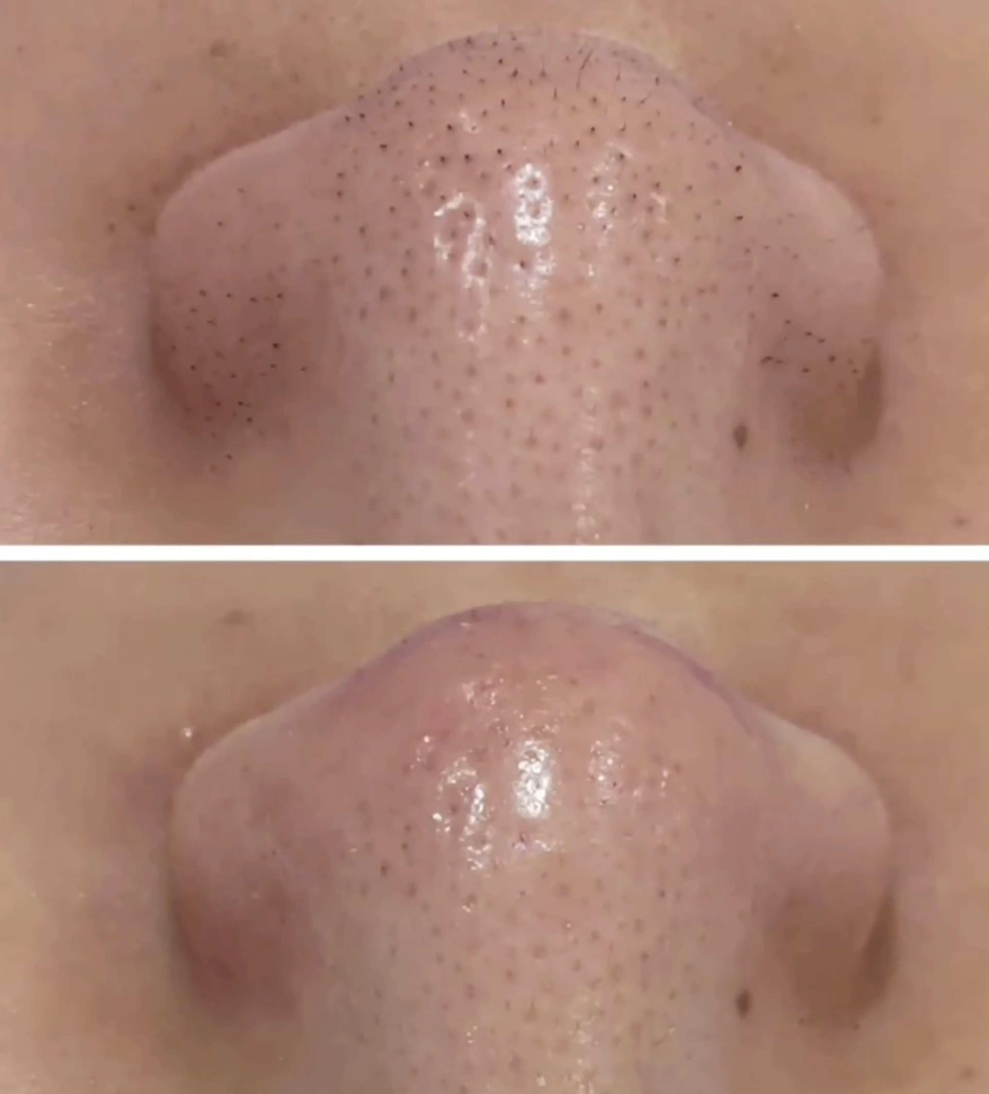 【毛穴洗浄シルバー】超音波スチームで毛穴をしっかり開いて丁寧に毛穴の汚れを取り除きます!の写真