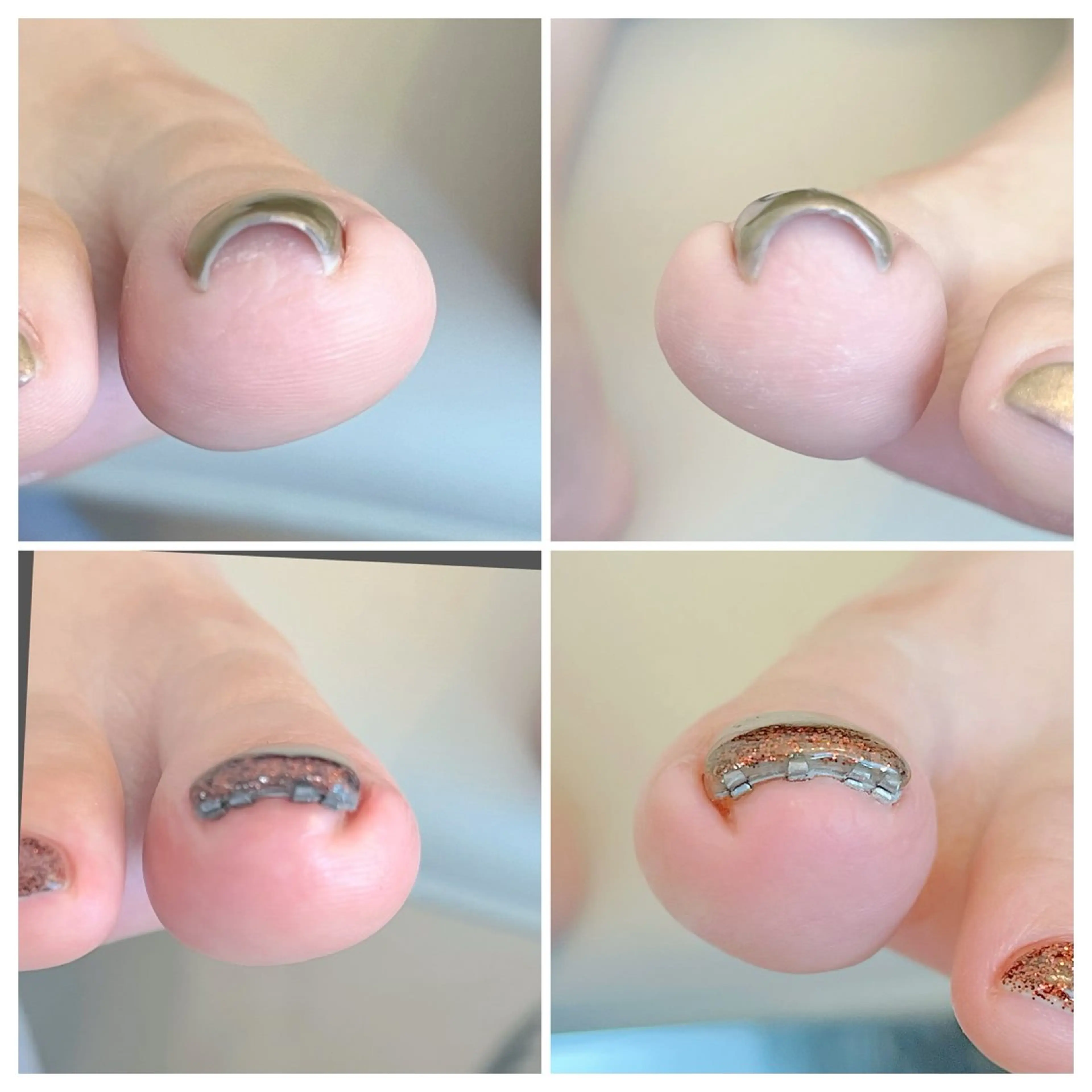 【モニター募集】フット巻き爪矯正¥12000→¥6000の写真