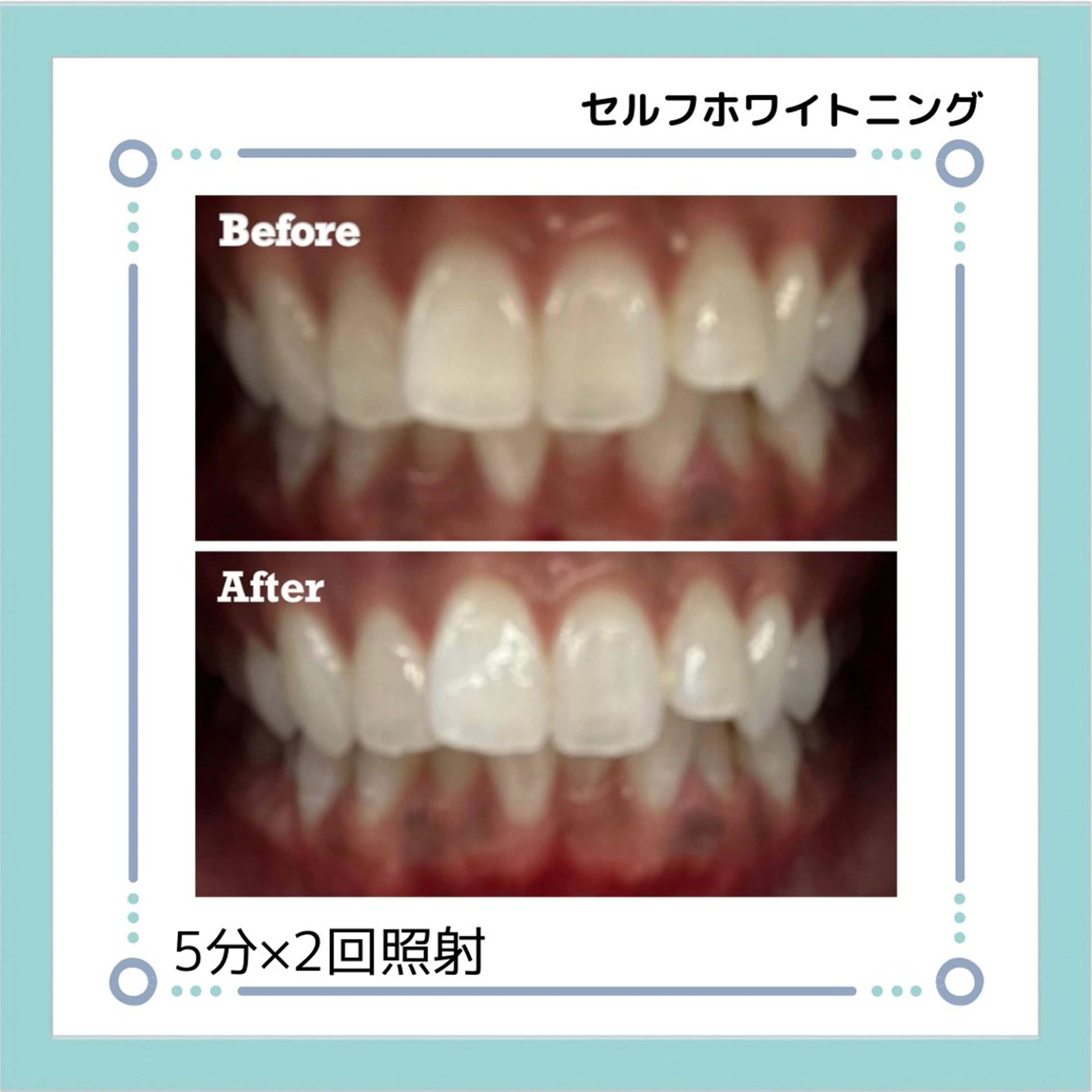 セルフホワイトニング【５分×3回照射】の写真