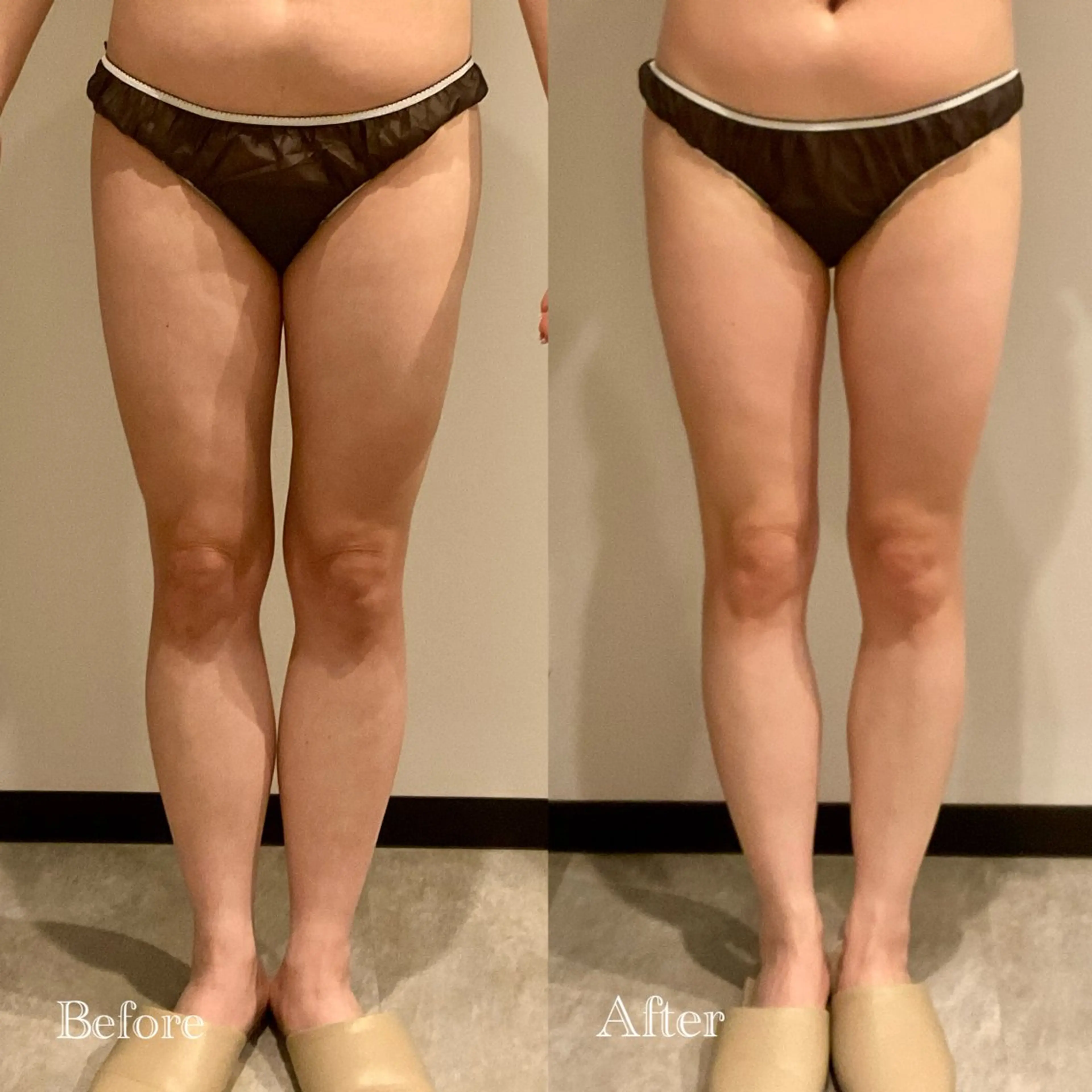 スタッフ🈯️【下半身集中70分🔥美脚コース✨】頑固な凸凹脂肪へアプローチ🔥細い脚を目指したい方、むくみ•冷え改善の写真