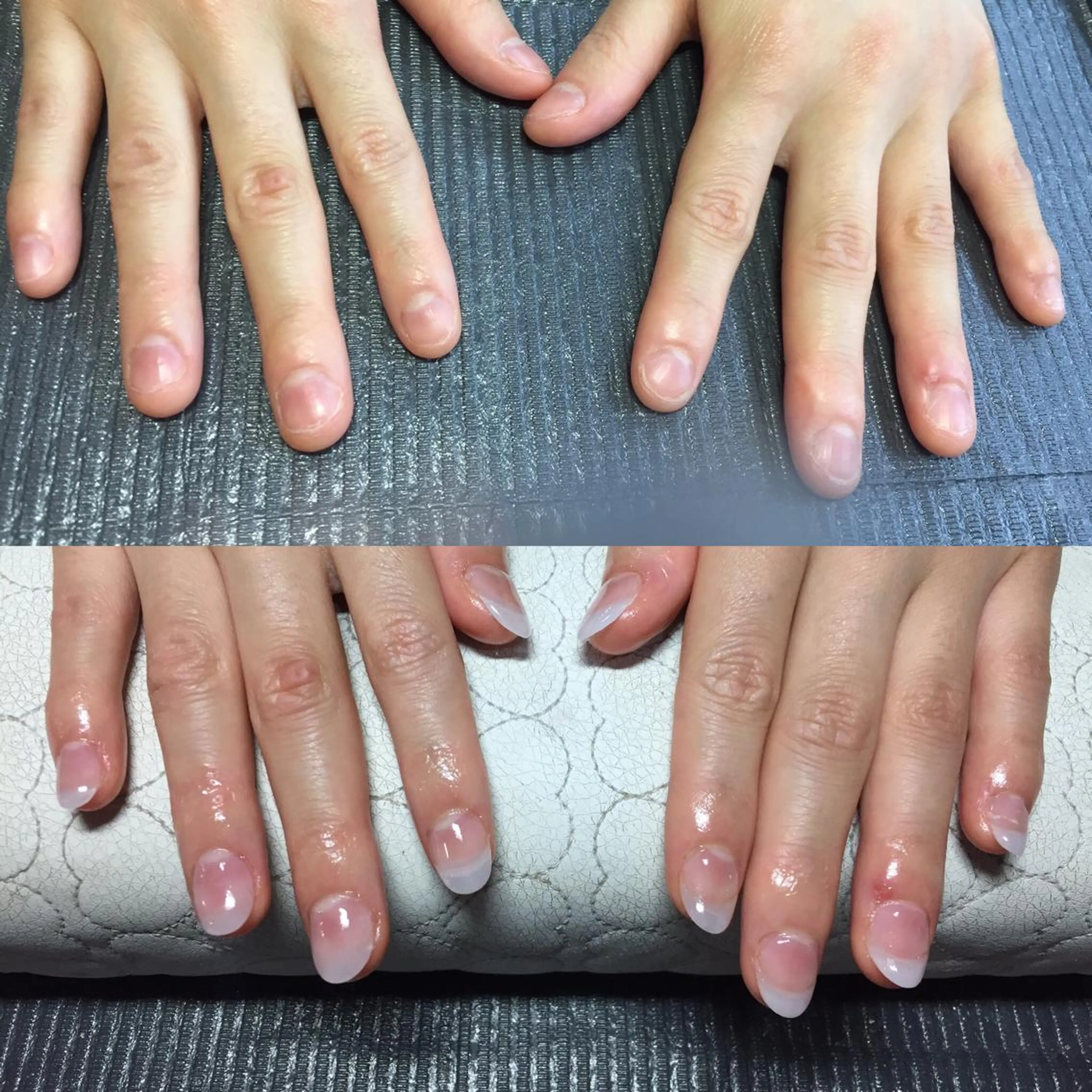 深爪矯正の写真