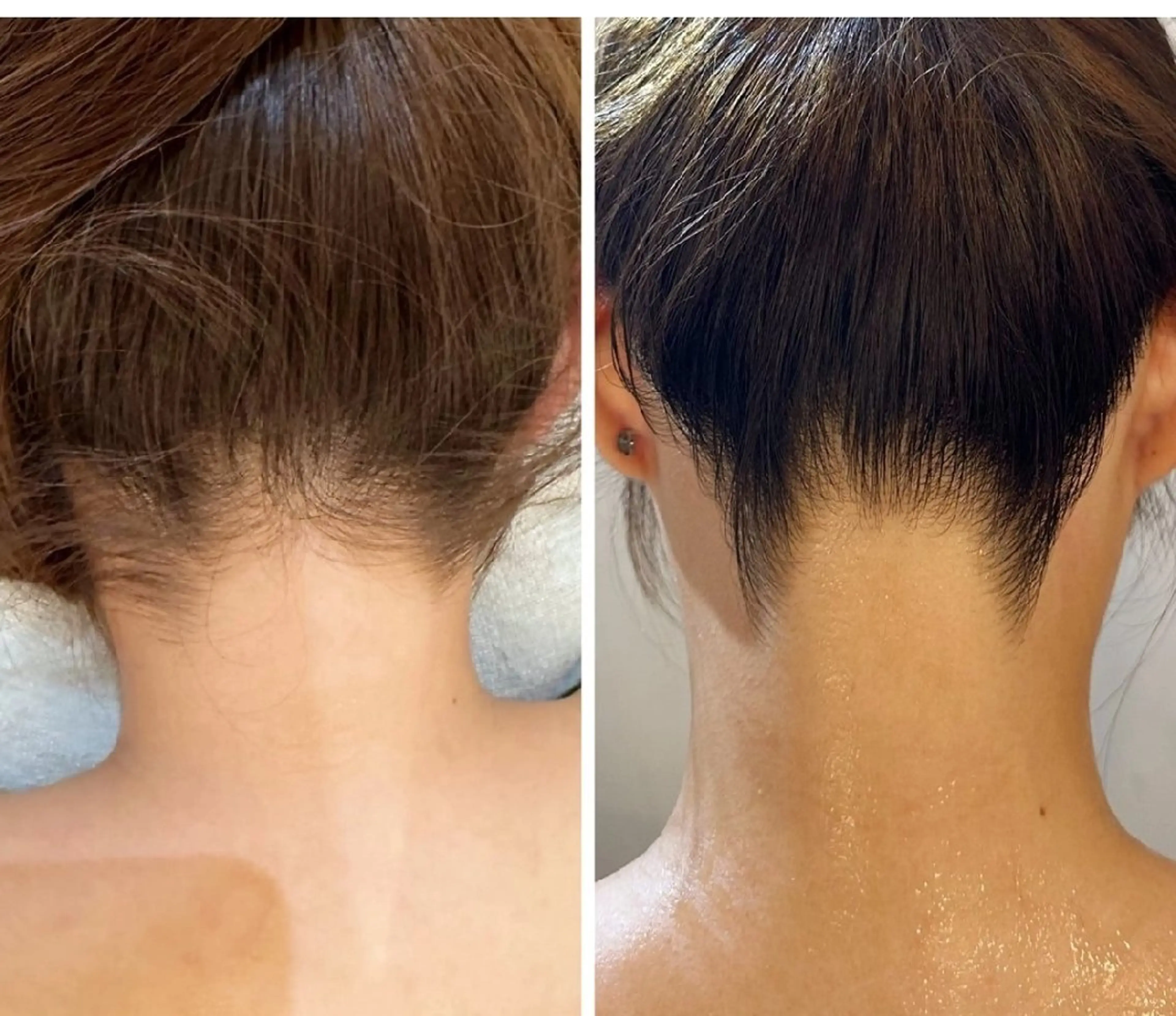 光ハイパワーIPL脱毛うなじデザイン　夏に向けて今から脱毛する事で、髪のアップスタイルにも差がでる！の写真