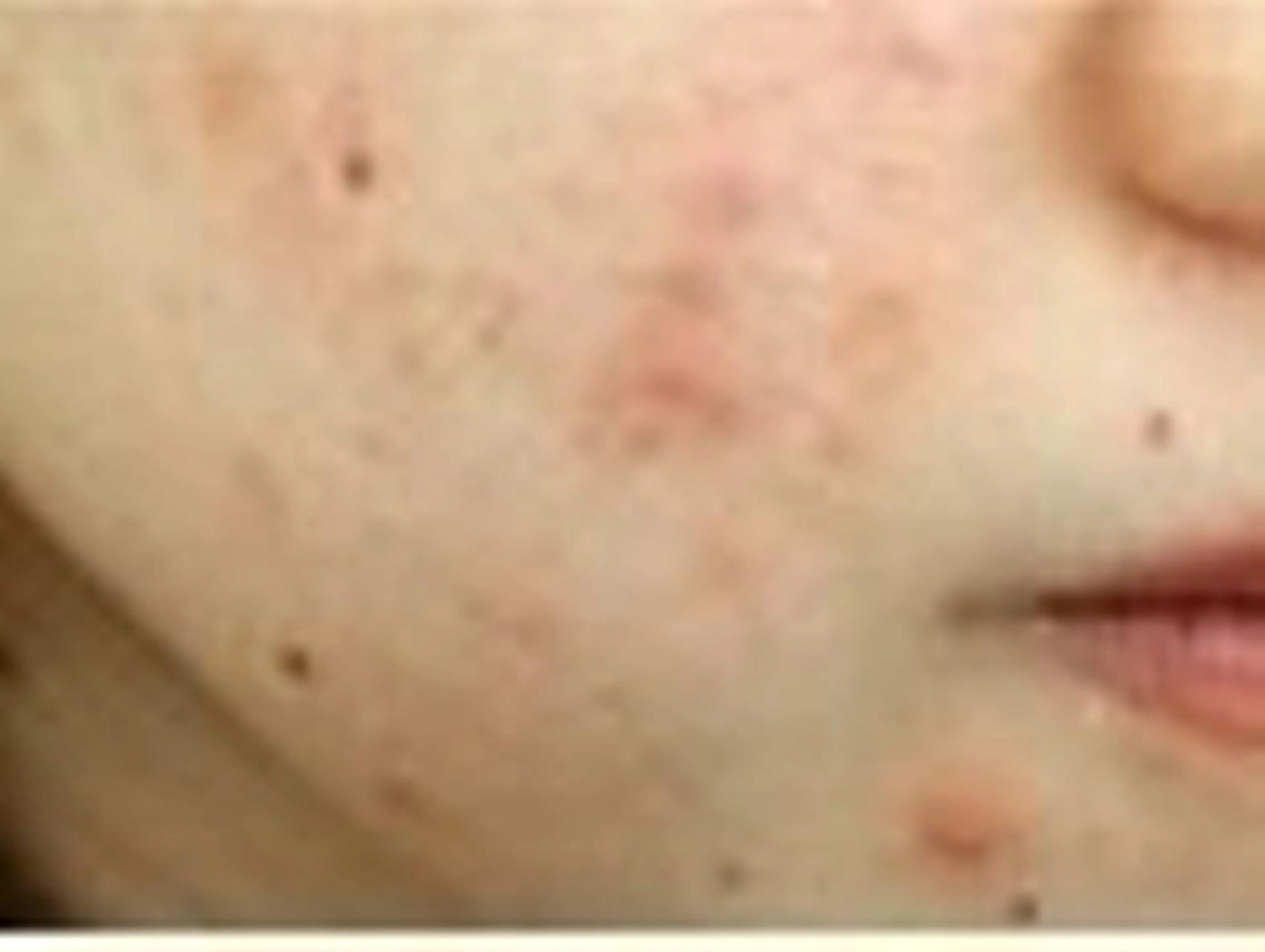 本気の肌質改善《ニキビケア/毛穴皮脂づまり》(贅沢7STEP)90分¥25000→4400の写真