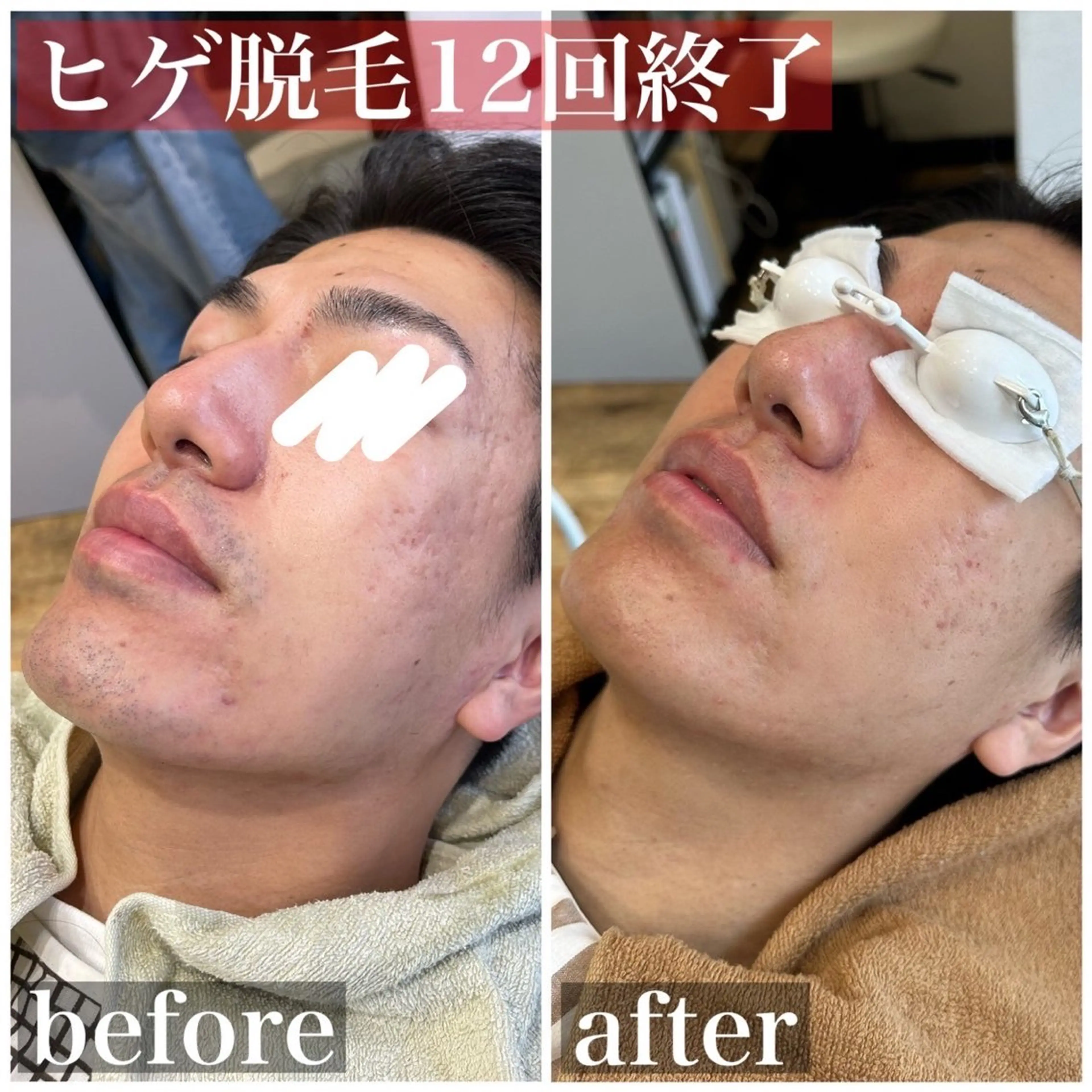 メンズ HAIRS YOSHIOKA所属・ヘアーズヨシオカ MENSヒゲ脱毛のエステ・リラクイメージ