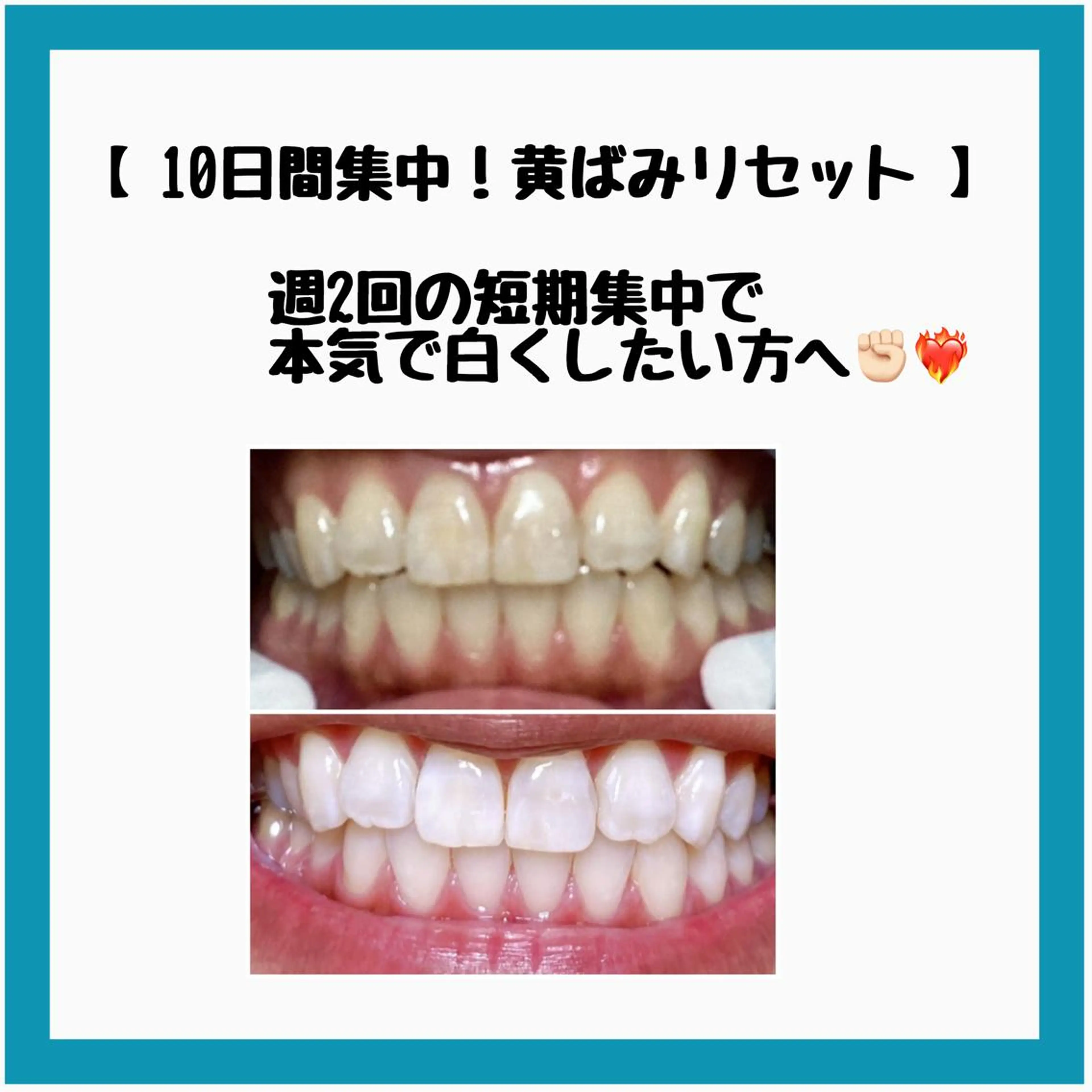 【週2回の10日間短期集中❣本気で歯を白くしたい方】新世代プラチナセルフホワイトニング🦷🪥(10回コース)の写真