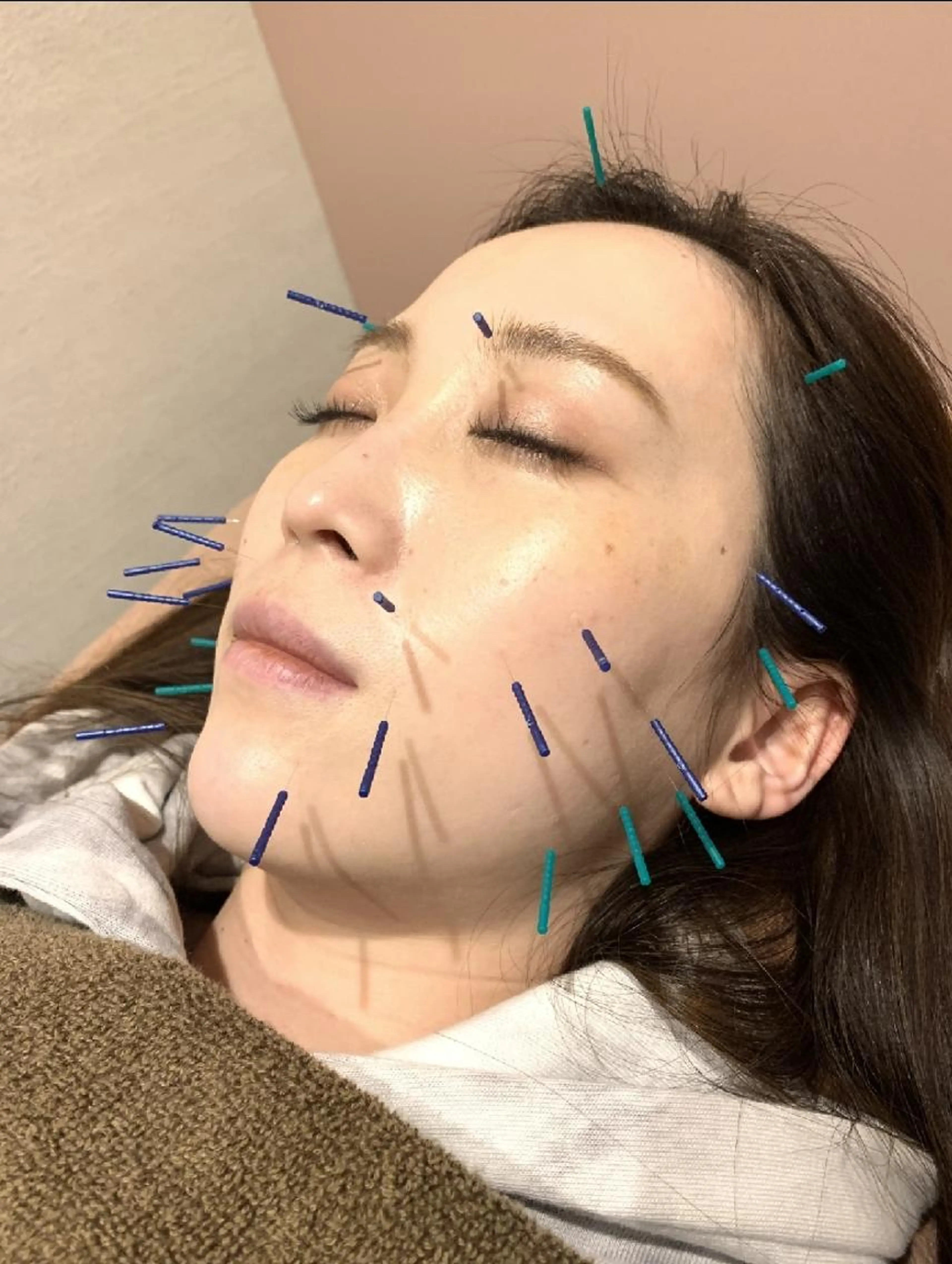 大人気🌟美容鍼💕😍の写真