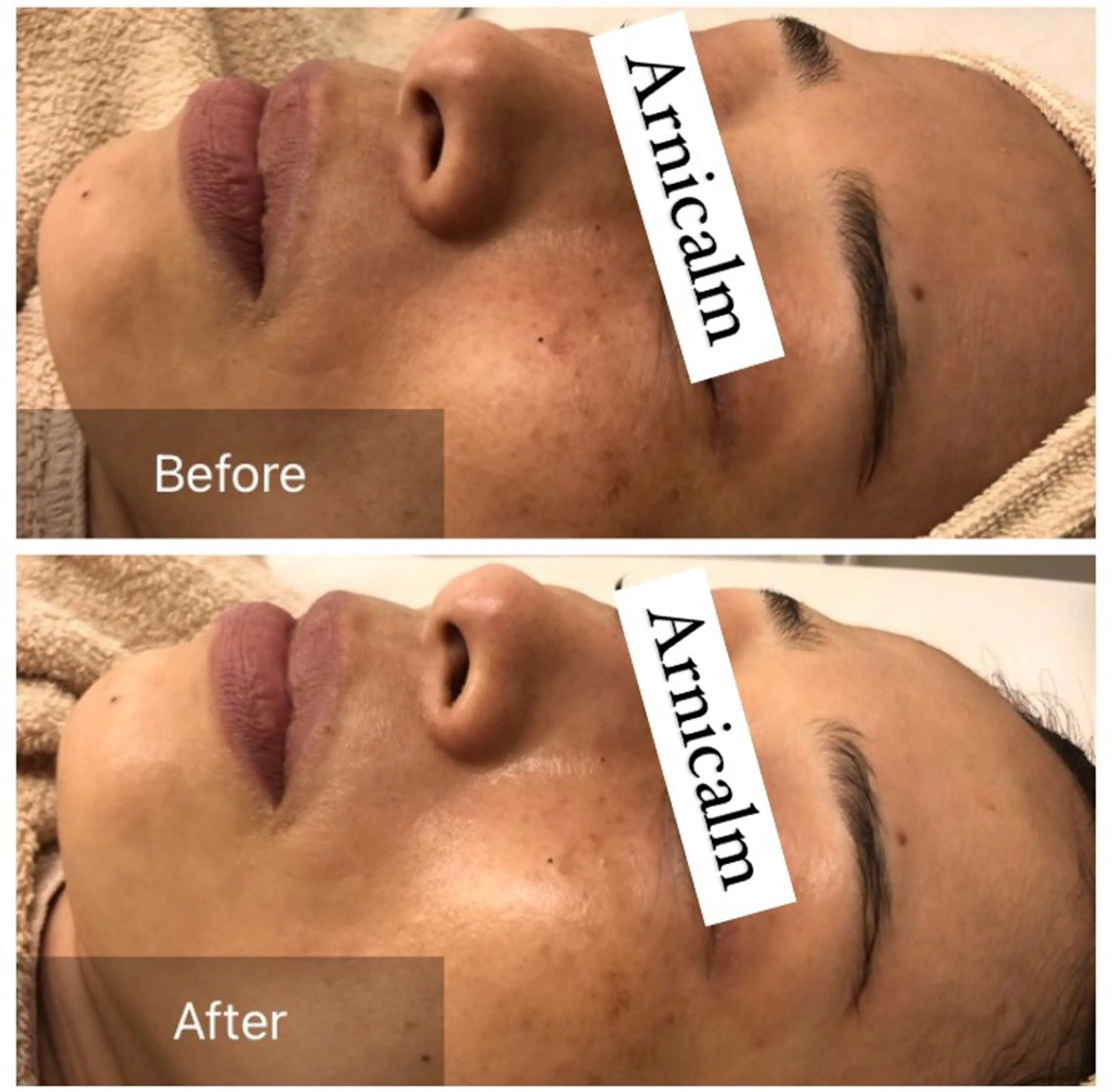 エステ ハーブピーリング 肌再生ピーリング/のエステ・リラクイメージ