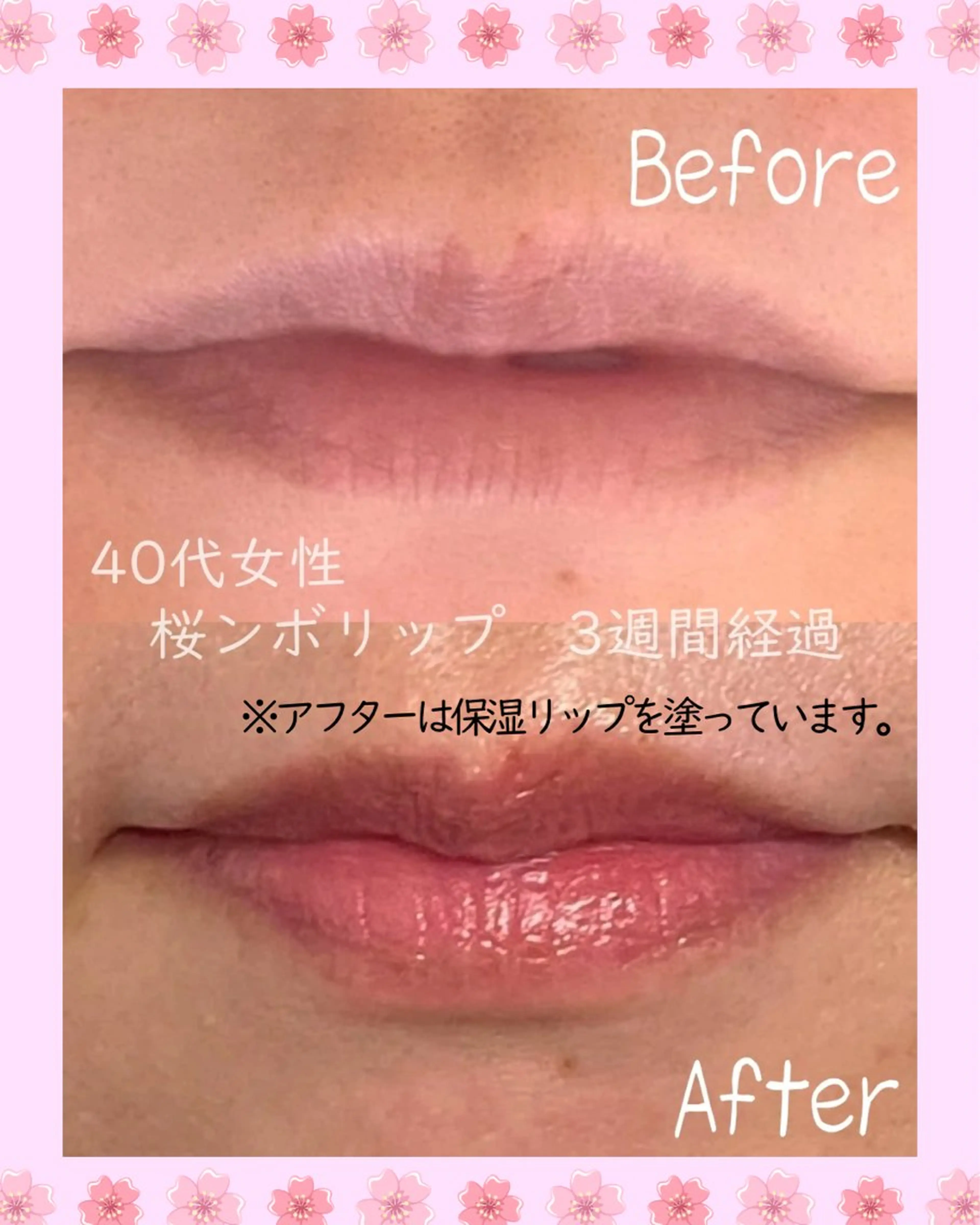 【唇の乾燥が気になる方】🌸桜んぼリップカウンセリング＋ドライヘッドマッサージ30分／2,000円🌸の写真