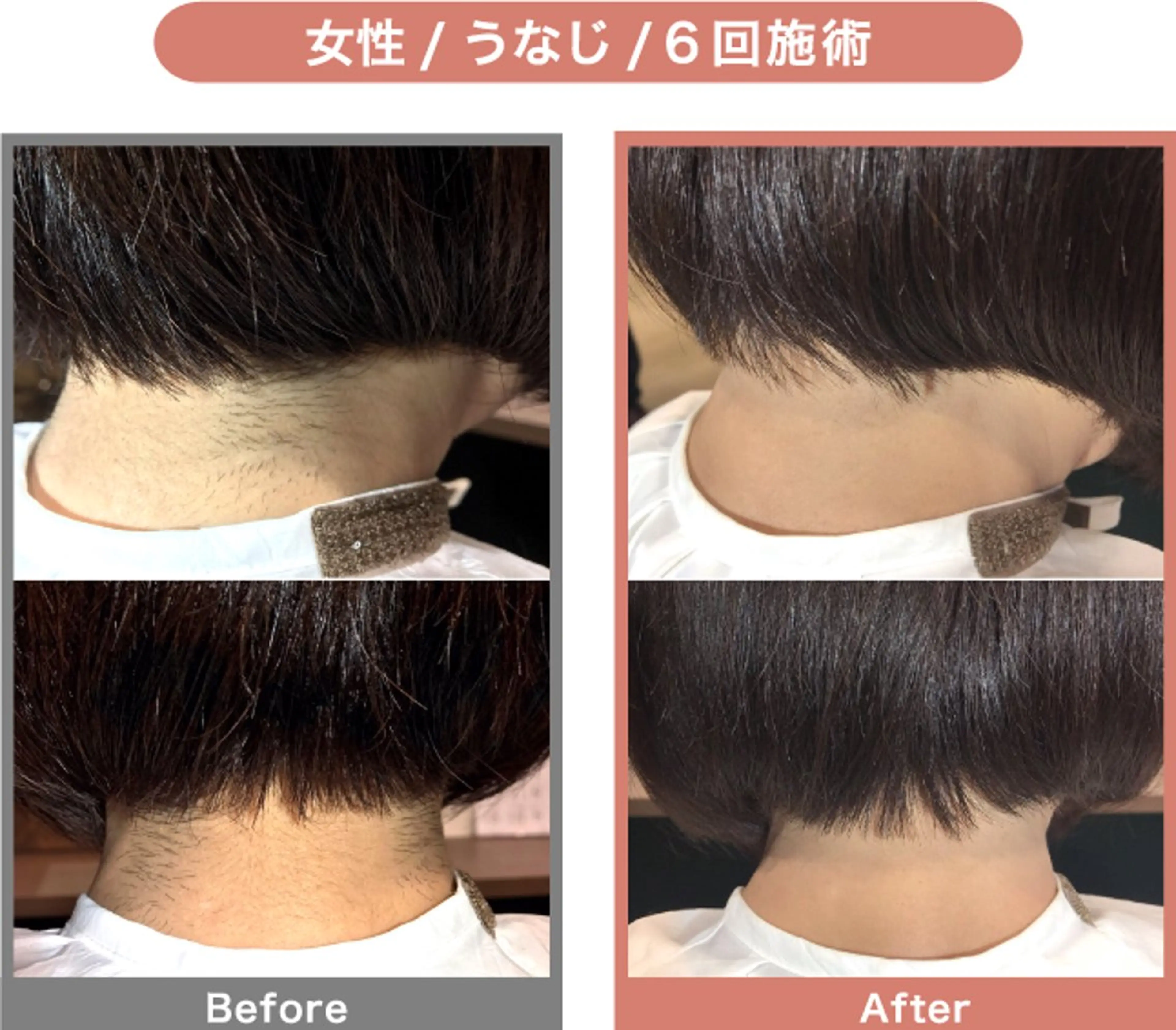 産毛にも反応する機械で1週間に1回施術可能！選べるパーツ脱毛:うなじ、手【指】足【指】V、O、Iラインから3種類の写真