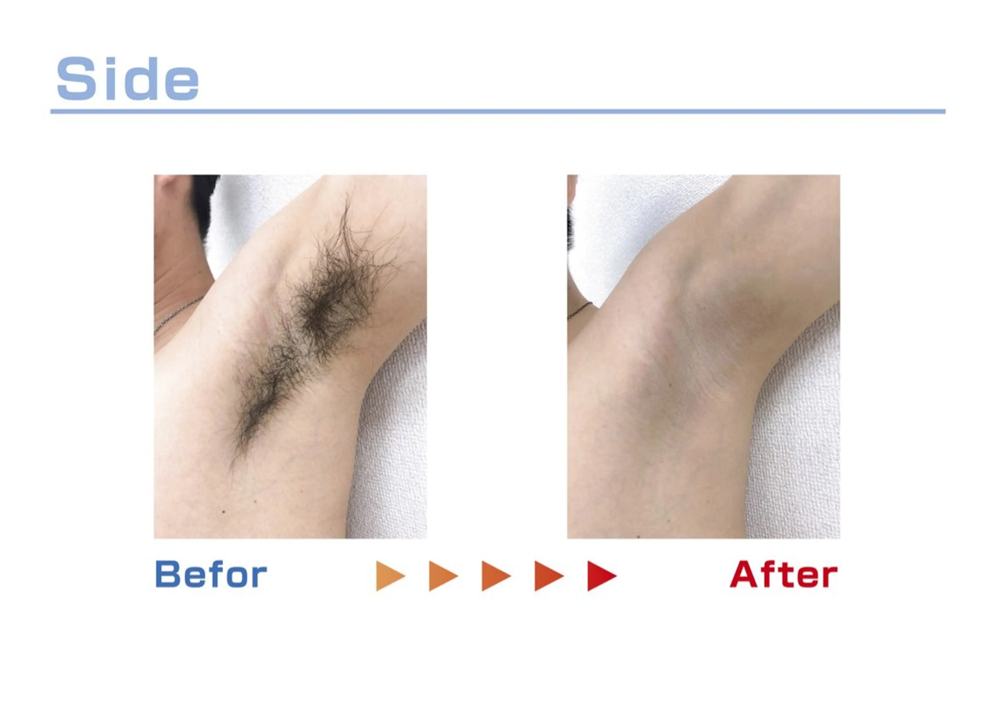 セルフ脱毛/美尻イス キングスサロン熊本のエステ・リラクイメージ