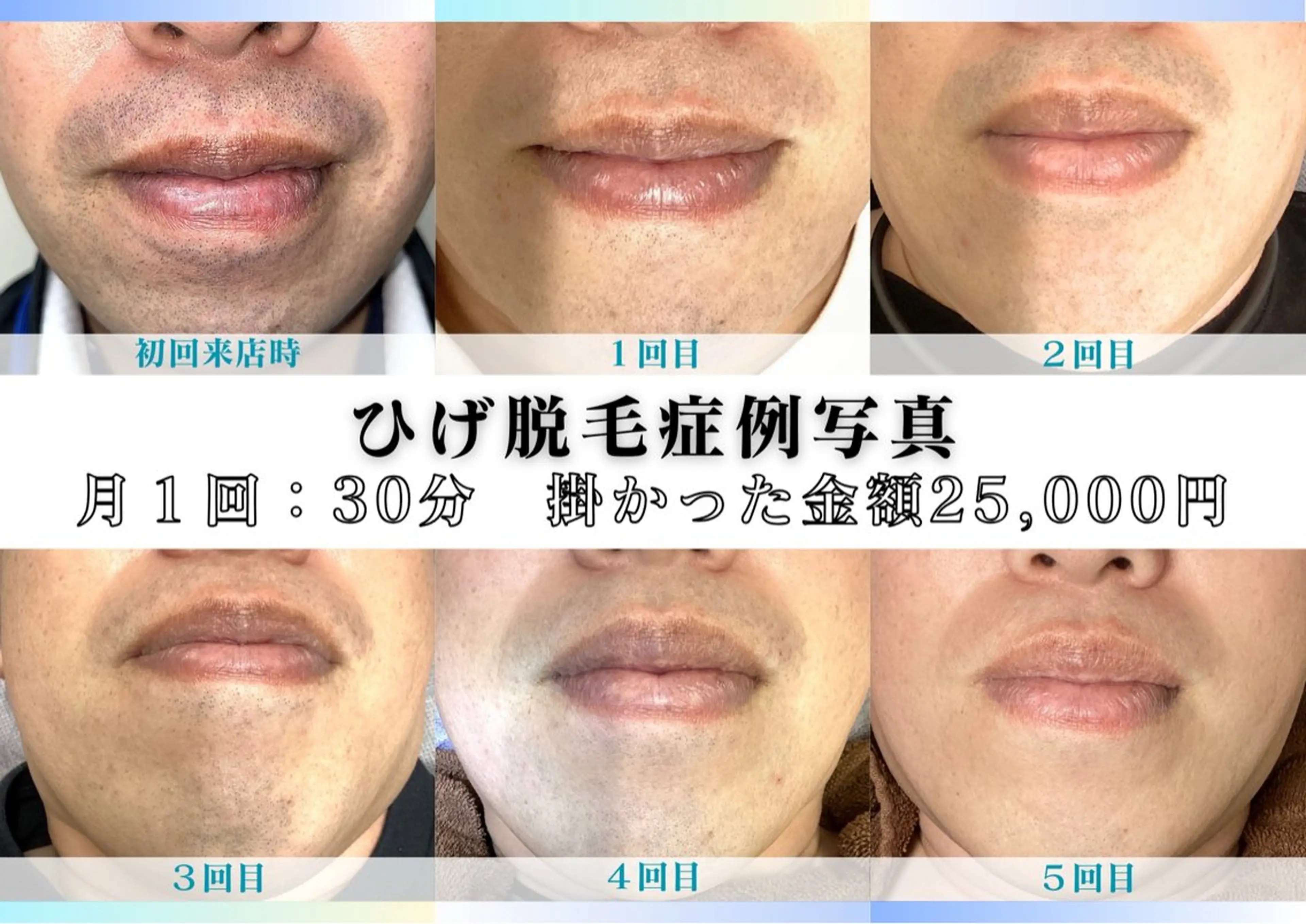 メンズ　全身フル脱毛THR照射(IPLベース)ヒゲ​〜​VIO込の写真