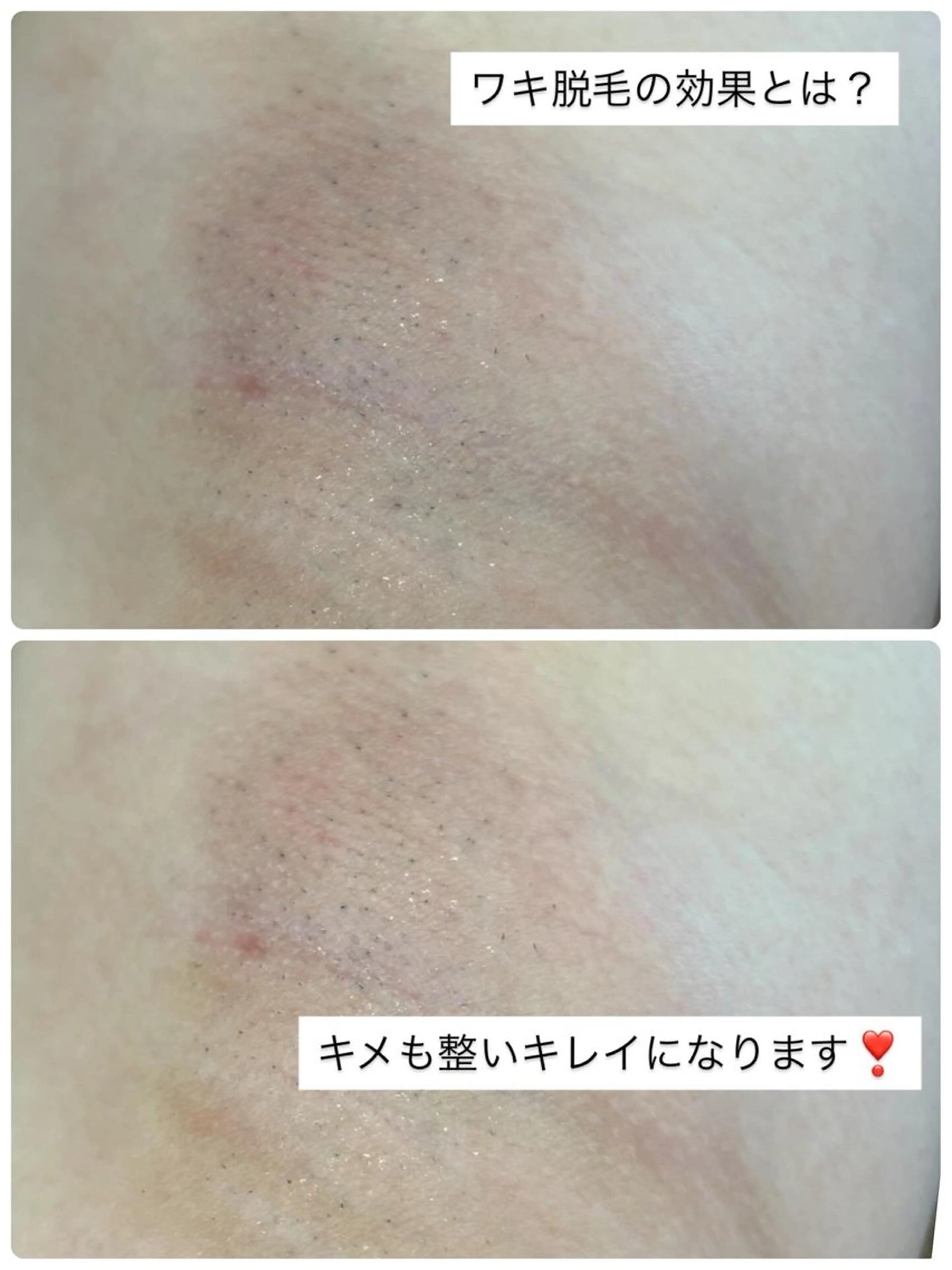 女性限定♡全身脱毛（顔、VIO)込み🩵¥7800の写真