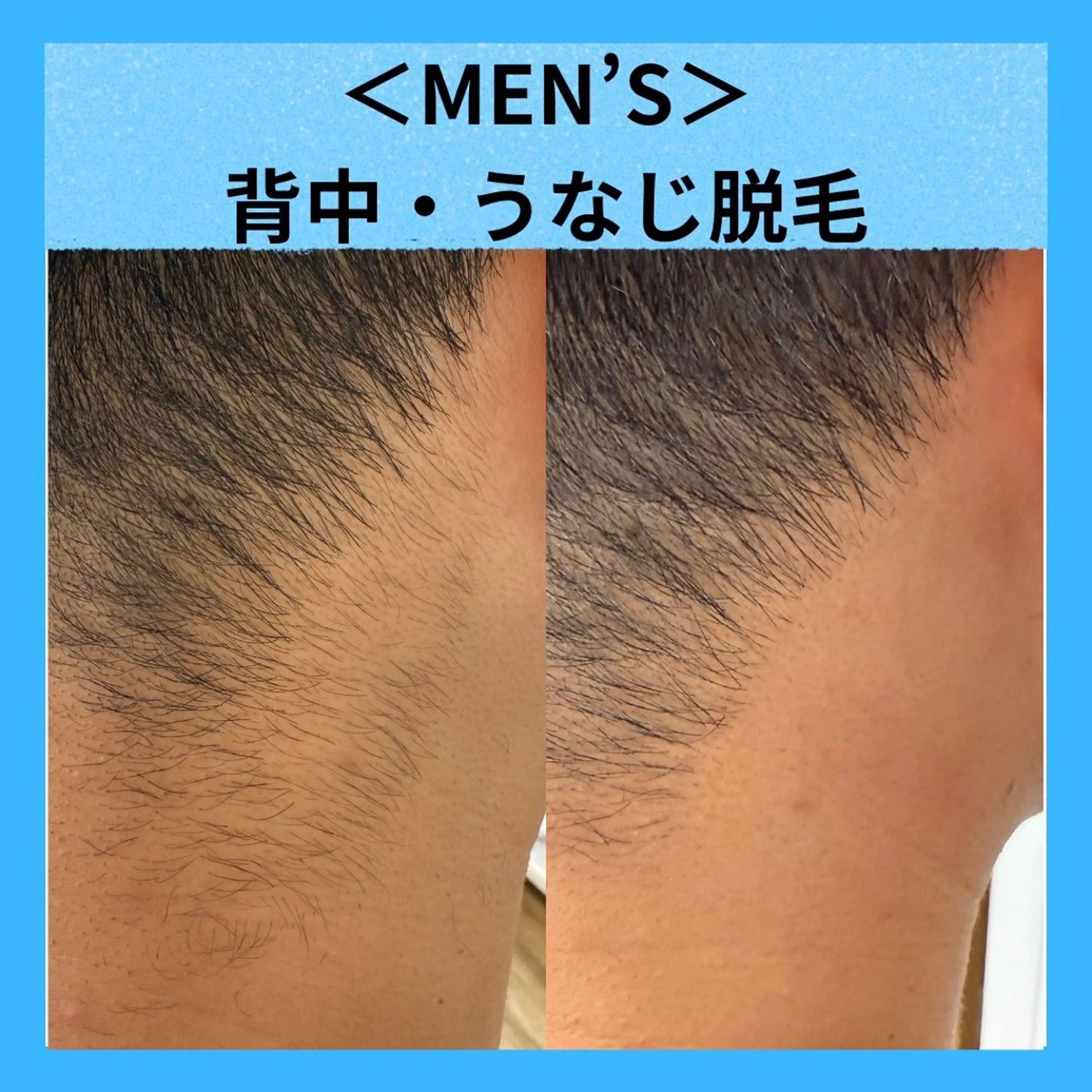 【メンズ脱毛】うなじ・背中の脱毛体験2,750円の写真