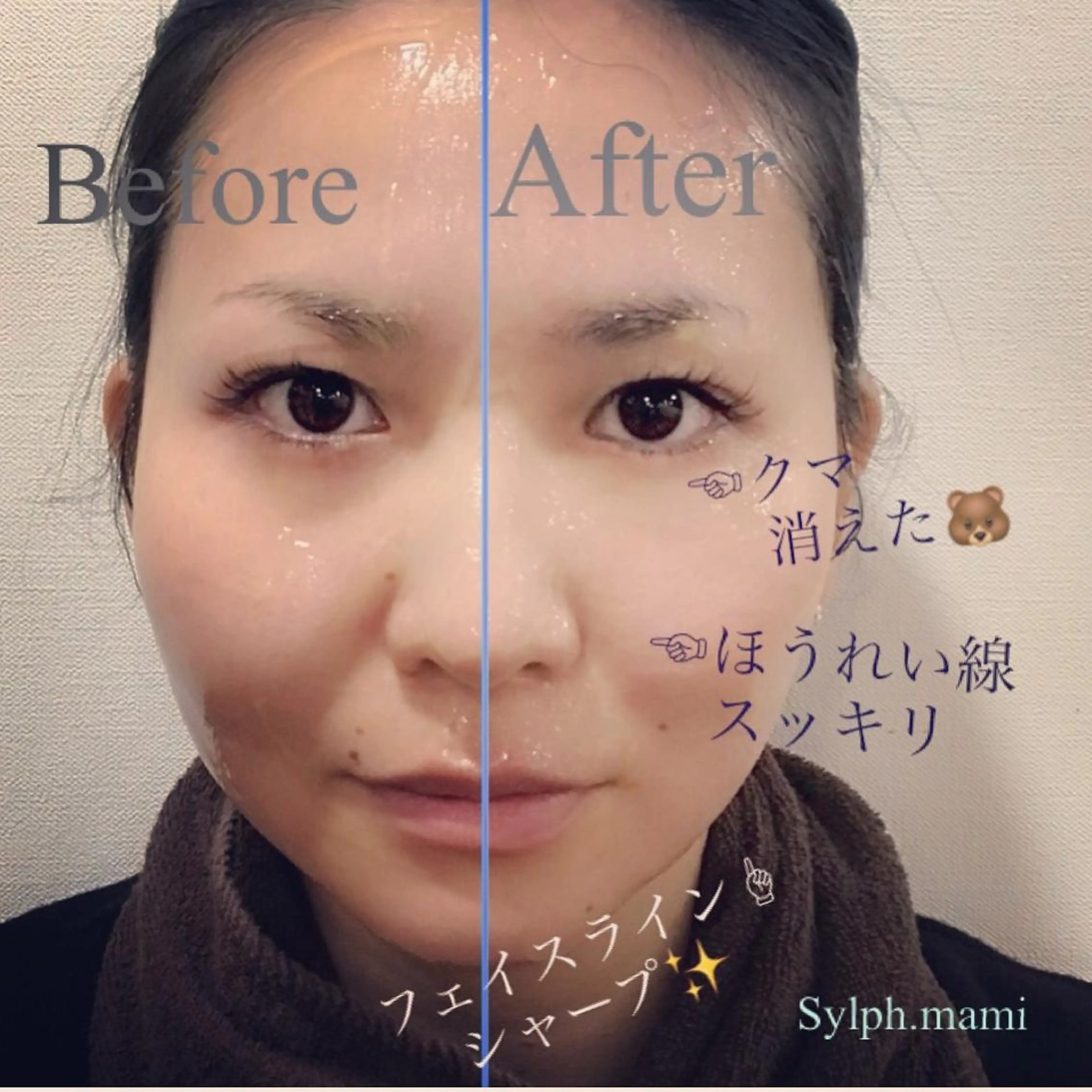 【即効性◎スッキリ小顔の美肌リフトアップ】お顔の筋肉を高周波電流を使い引締めトレーニング‼️透明感抜群の美肌小顔へ✨の写真