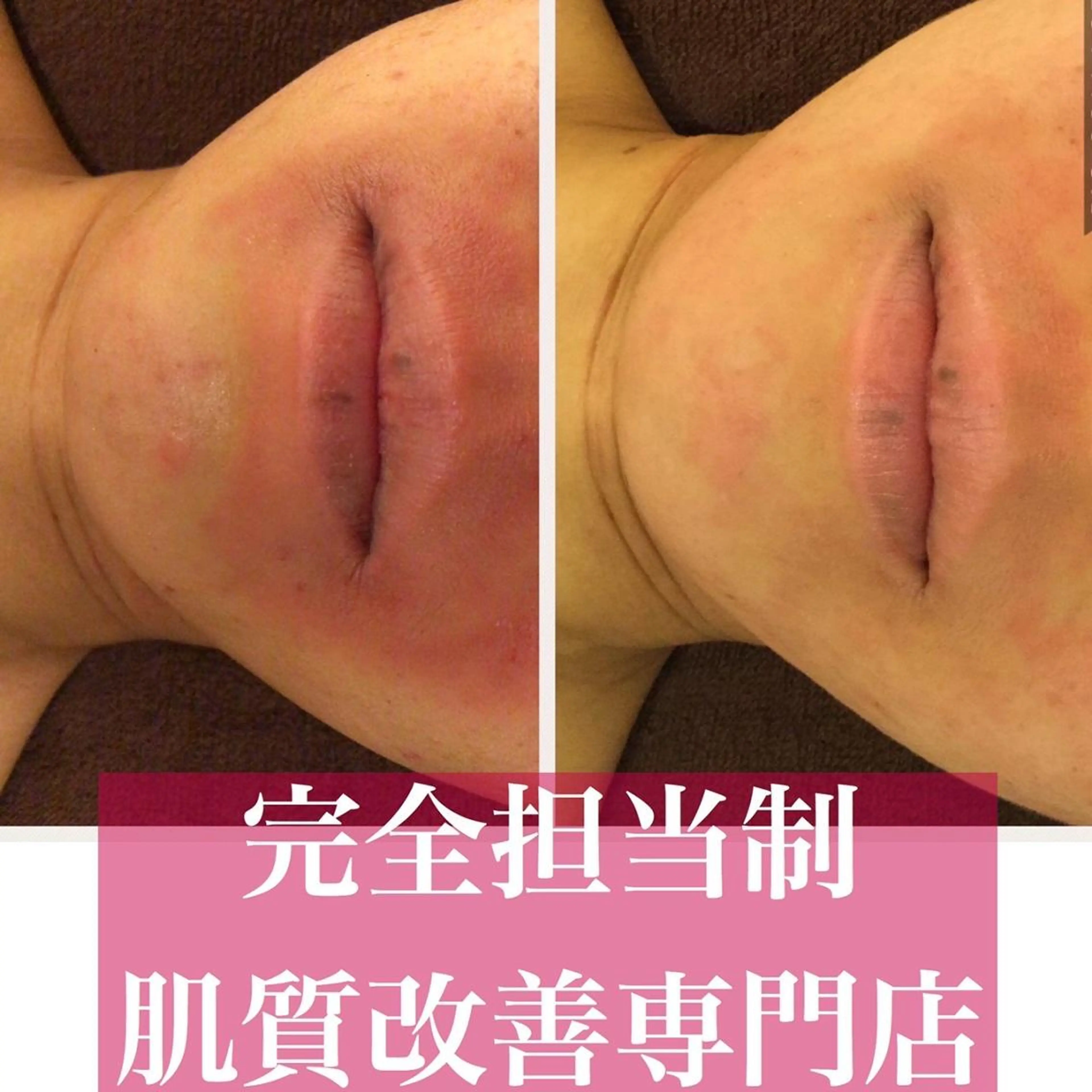 都内で出来る肌管理! 最短ニキビ改善のエステ・リラクイメージ