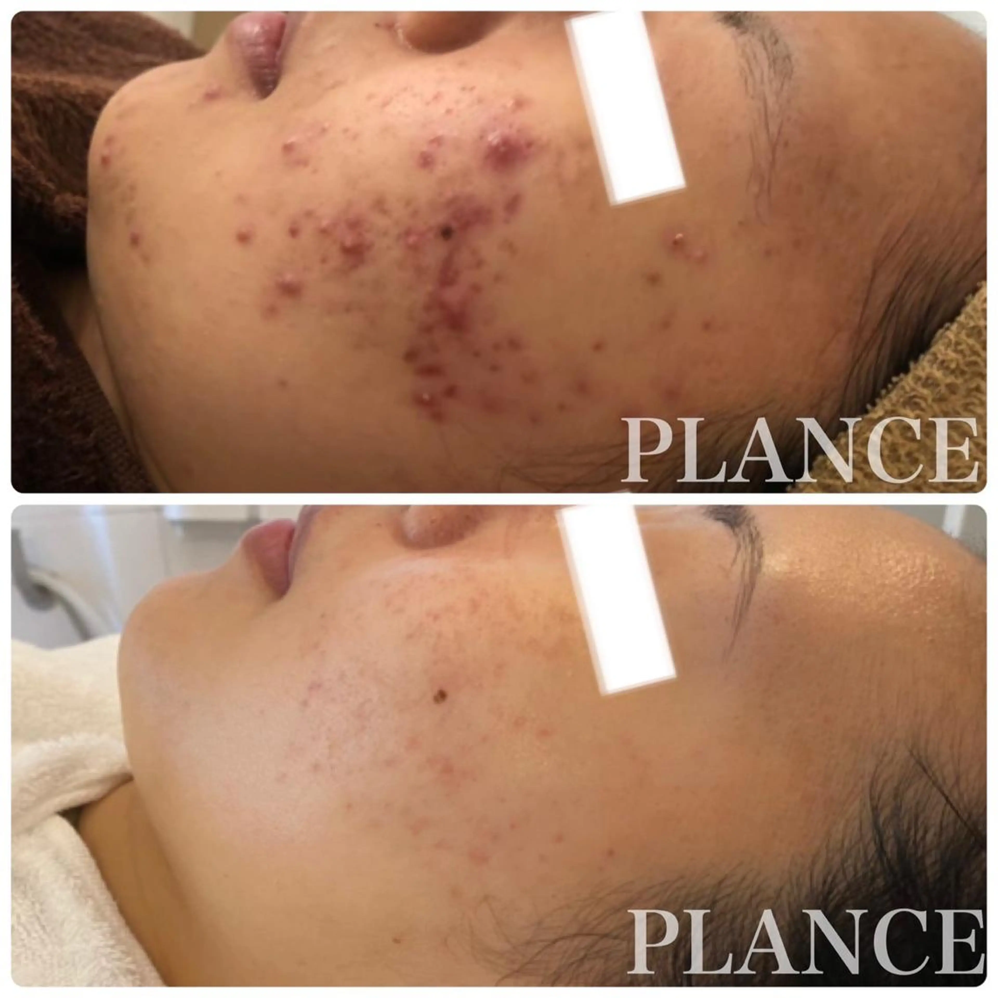 🌈ニキビ・毛穴改善✨PLANCEニキビケアフェイシャル プレミアム［75分］の写真