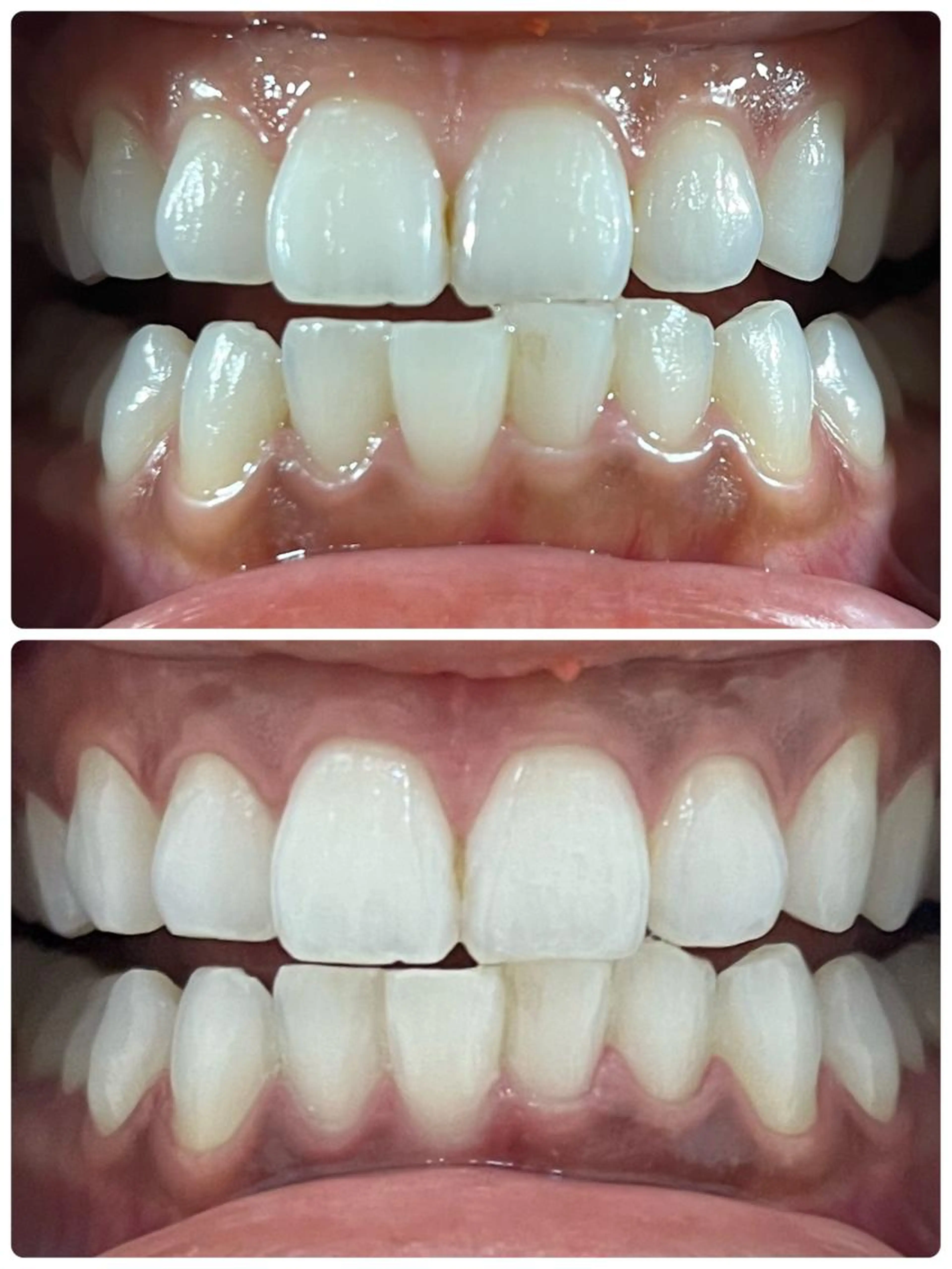 ホワイトニング【40分枠 予約用】回数券消化専用の写真