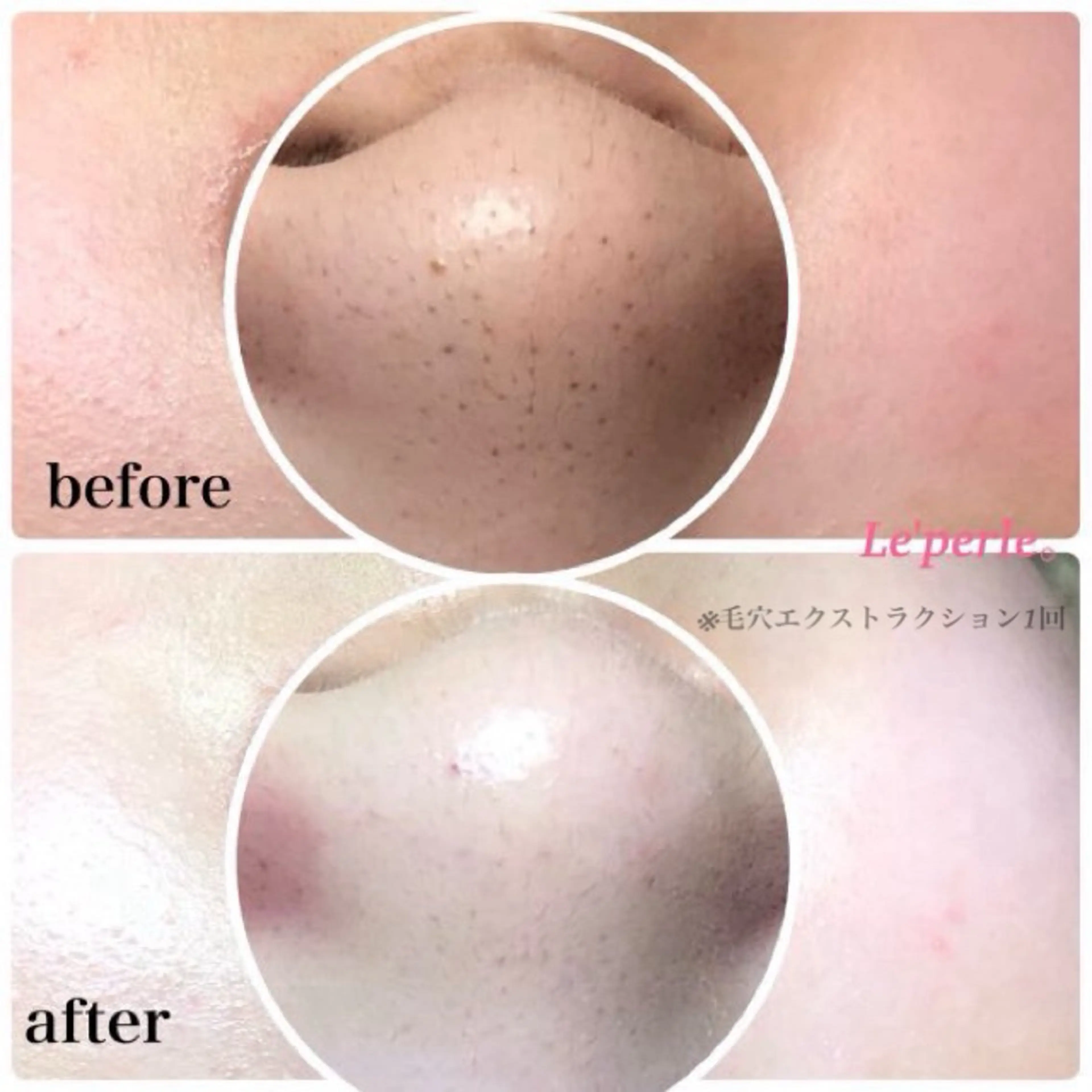 ごっそり毛穴角栓★徹底除去 毛穴エクストラクション（鼻のみ）➕生パックの写真