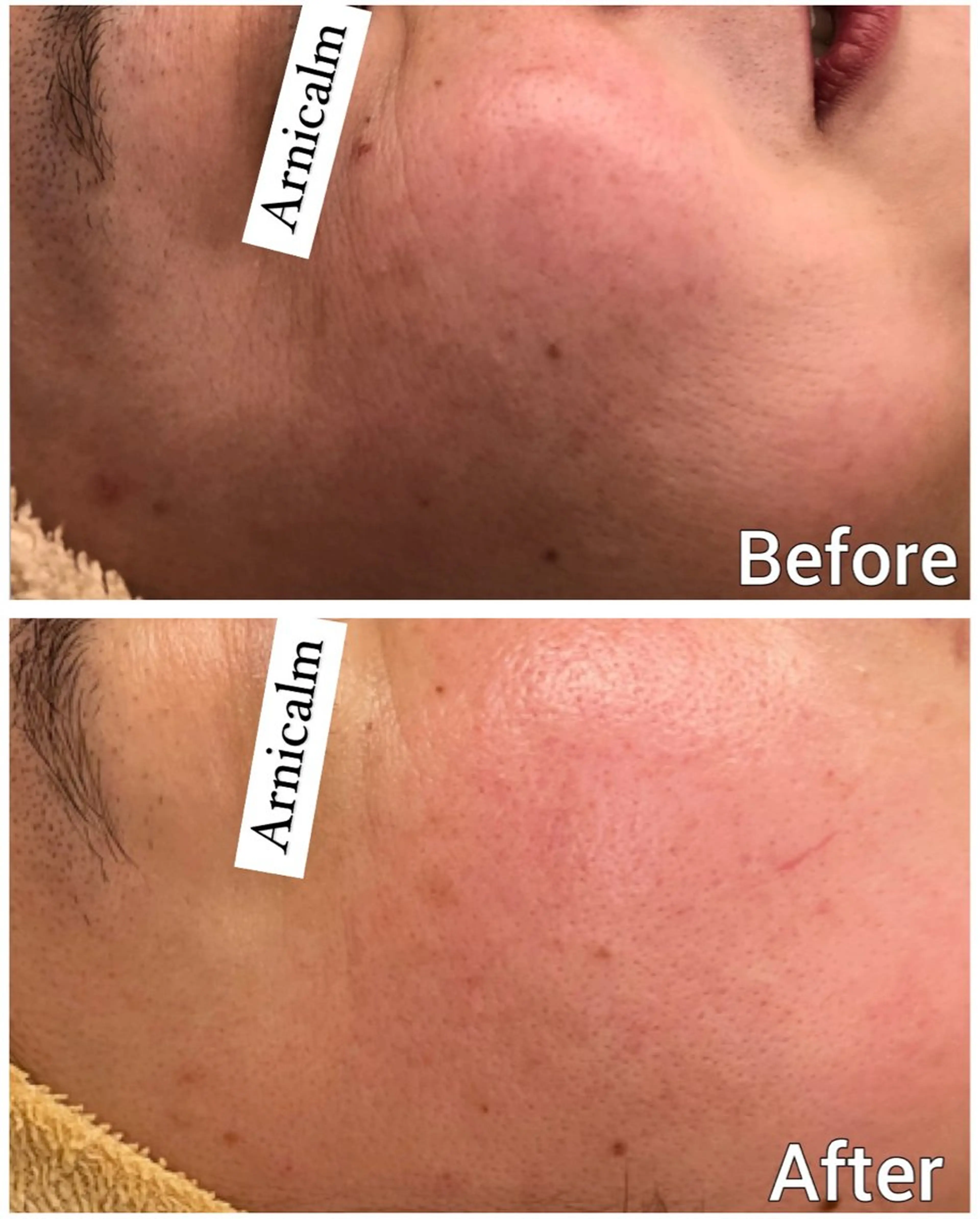 エステ ハーブピーリング 肌再生ピーリング/のエステ・リラクイメージ