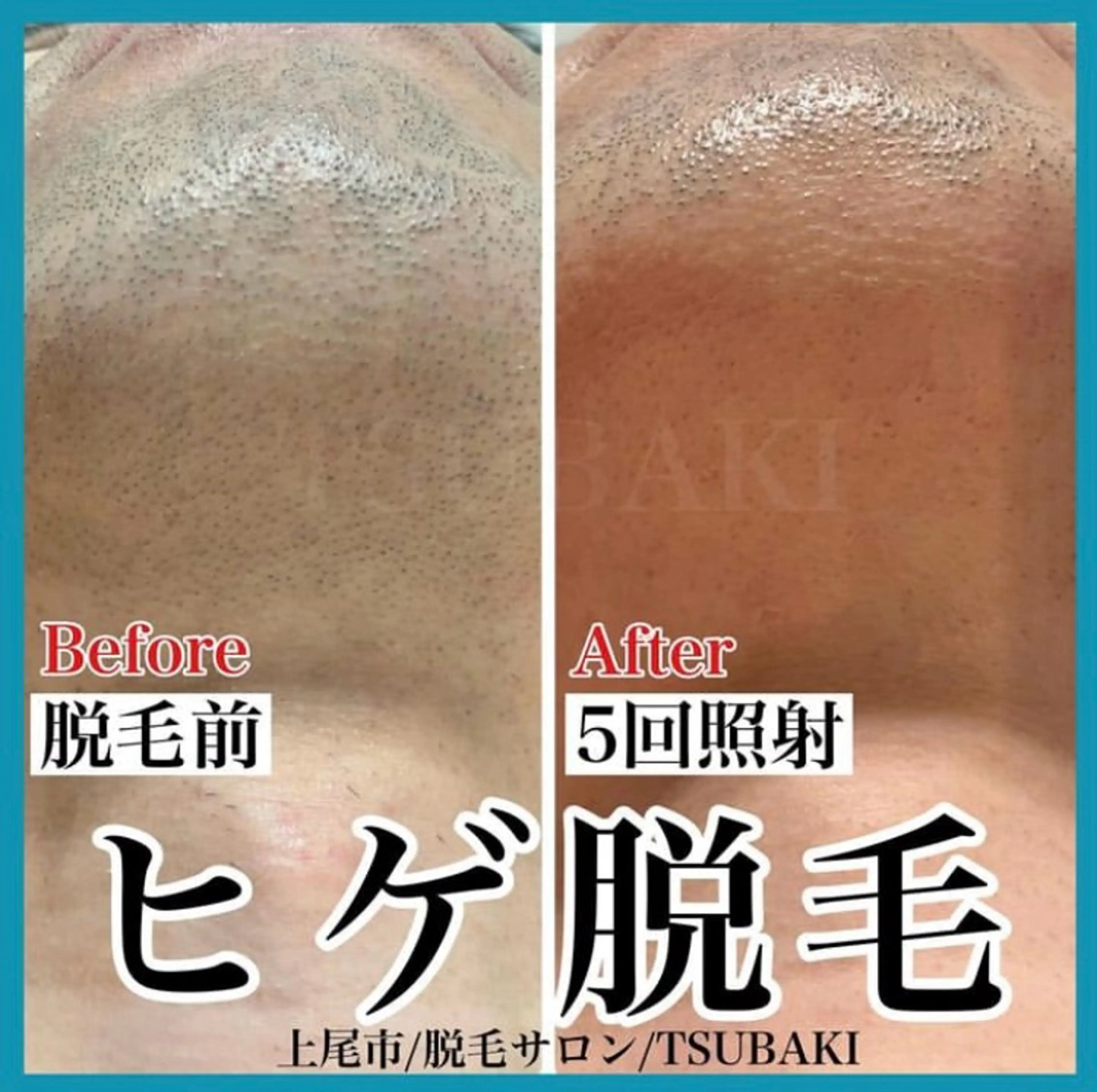 メンズ 脱毛 TSUBAKI上尾店所属・TSUBAKI上尾店 松下のエステ・リラクイメージ