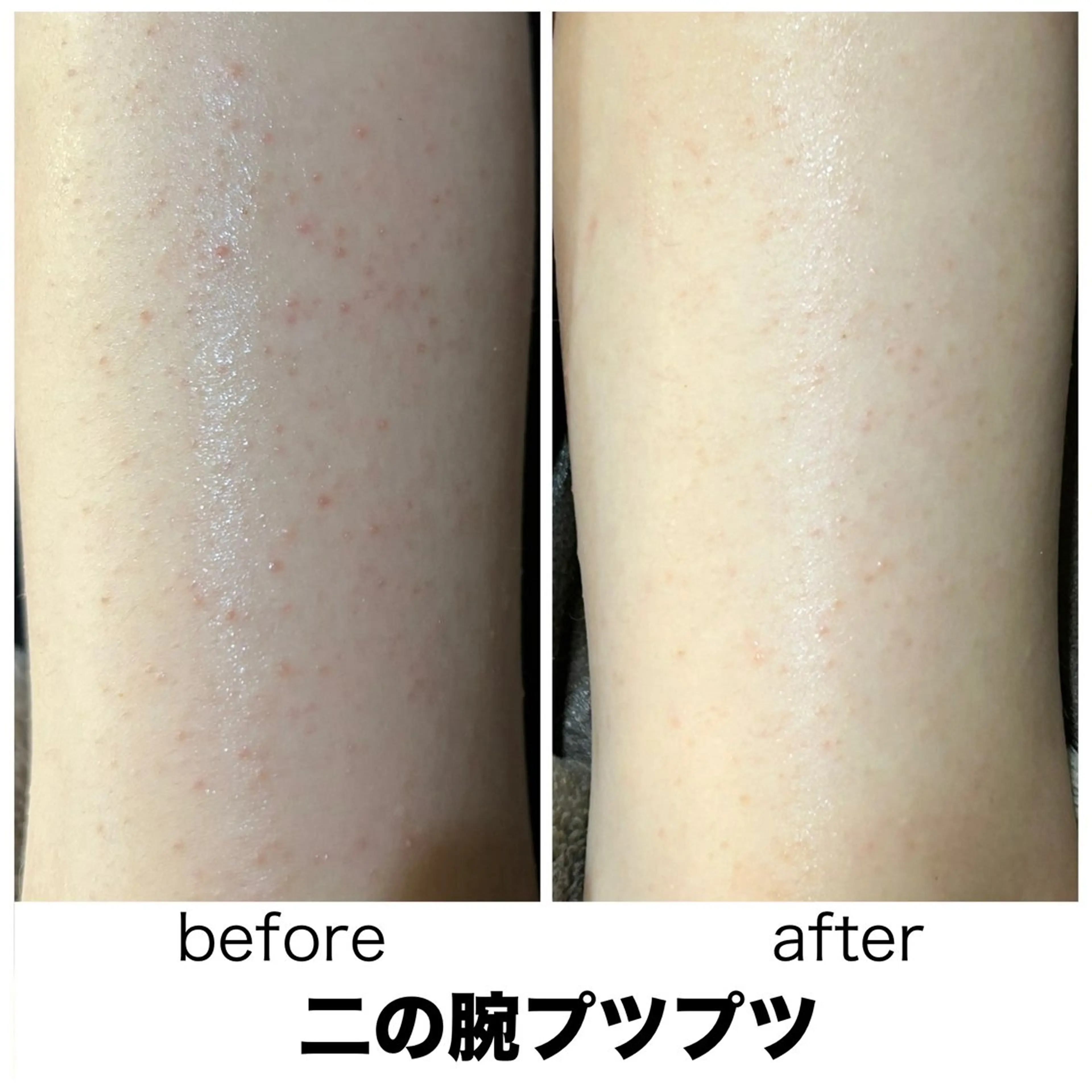 【二の腕のブツブツに◎】挙式・前撮り前に次世代ハーブピーリング🌿二の腕ザラつき集中ケアでつるすべ水光肌に♪の写真