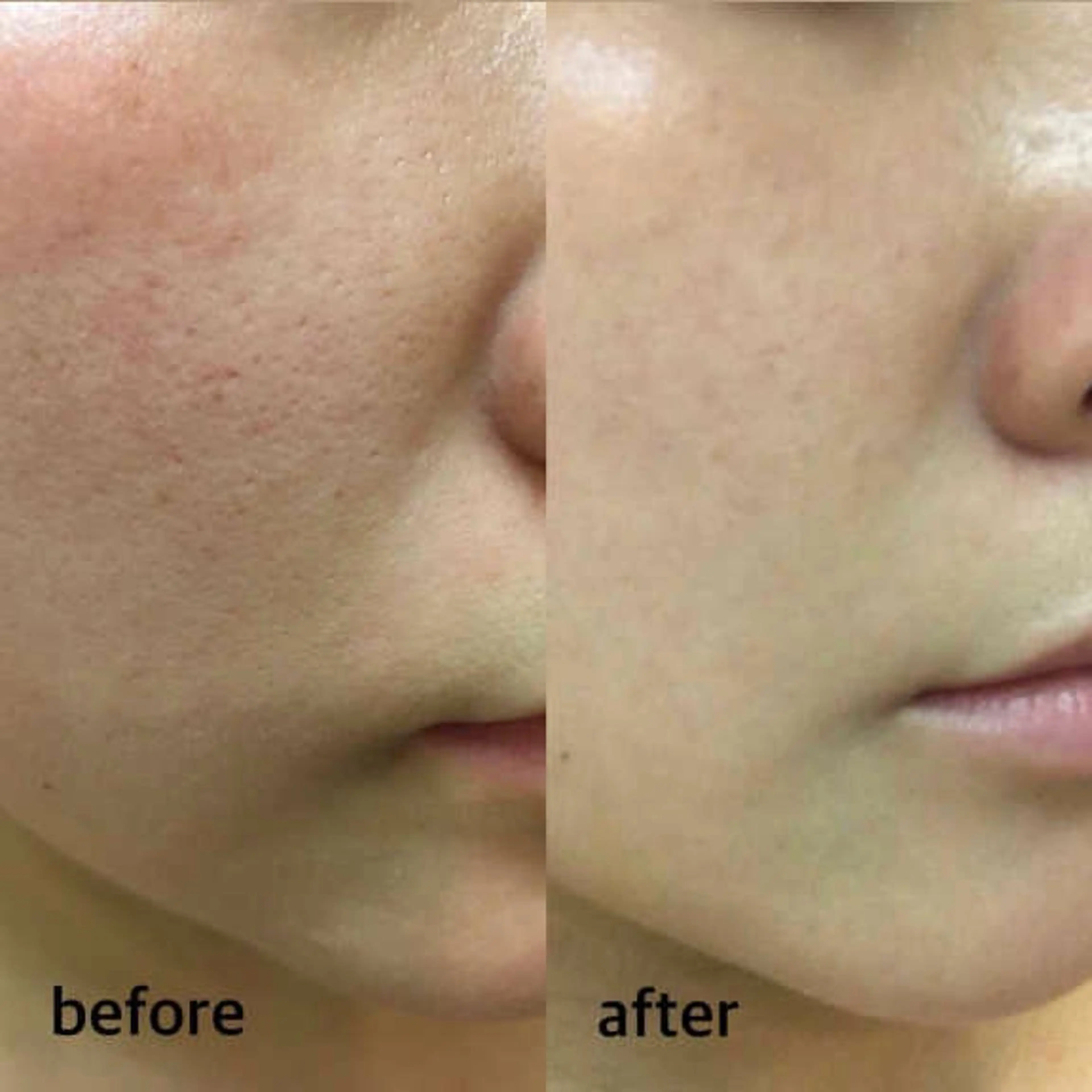 ハーブピーリング/韓国肌管理/フェイシャル/毛穴洗浄/眉毛/顔脱毛【糸脱毛専門】rev所属・ハーブピーリング🌹 毛穴洗浄❤️眉waxのエステ・リラクイメージ