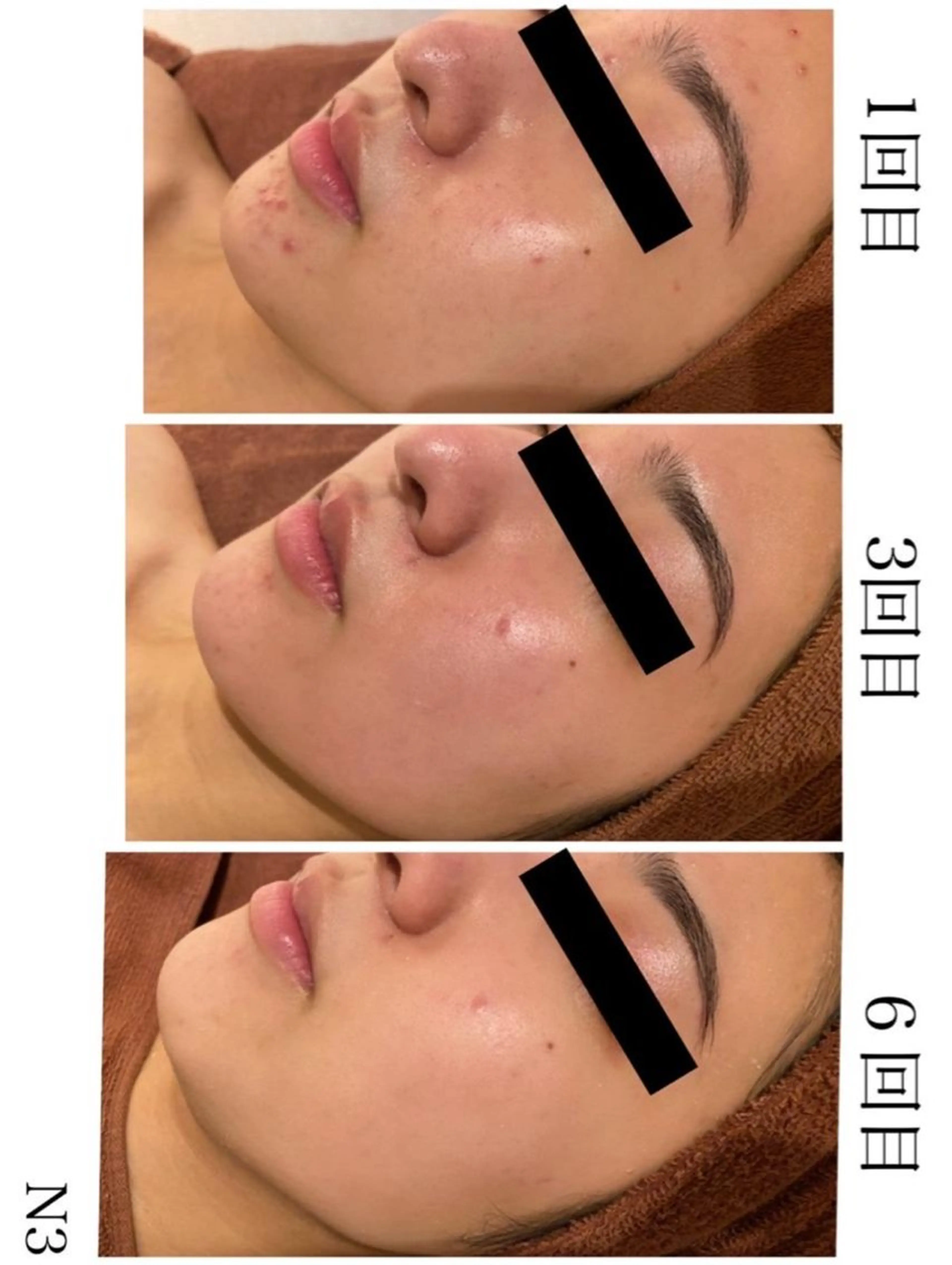 学生ニキビ改善🍀 優しい肌質改善のエステ・リラクイメージ