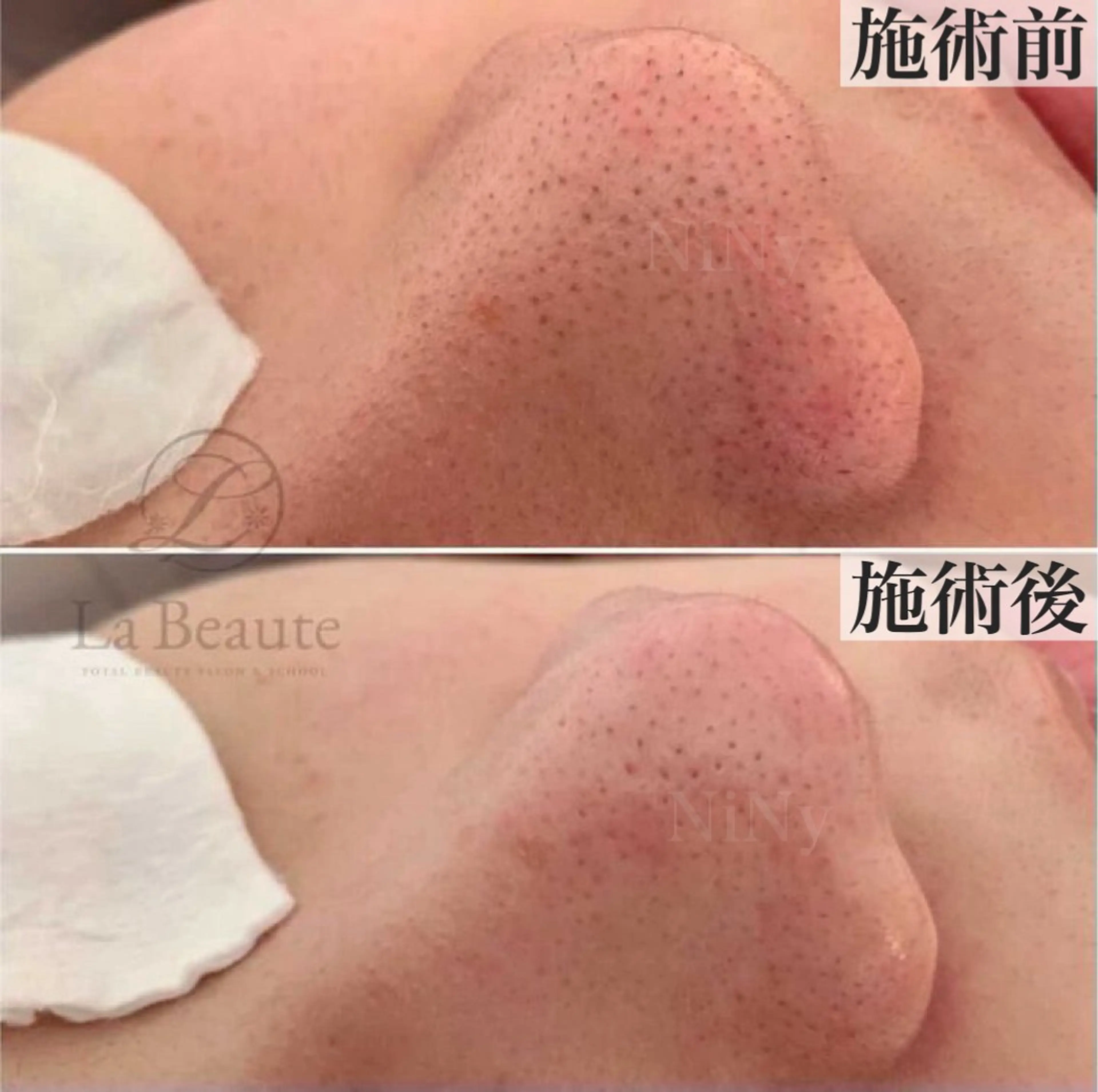 ご新規様【毛穴美人コース】毛穴の黒ずみ・詰まりでお悩み方におすすめ！　毛穴エクストラクションプロ認定サロンの写真